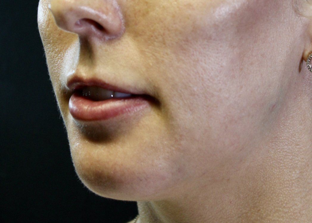 Picture of Chin Corrected by Dr Ruth Brady