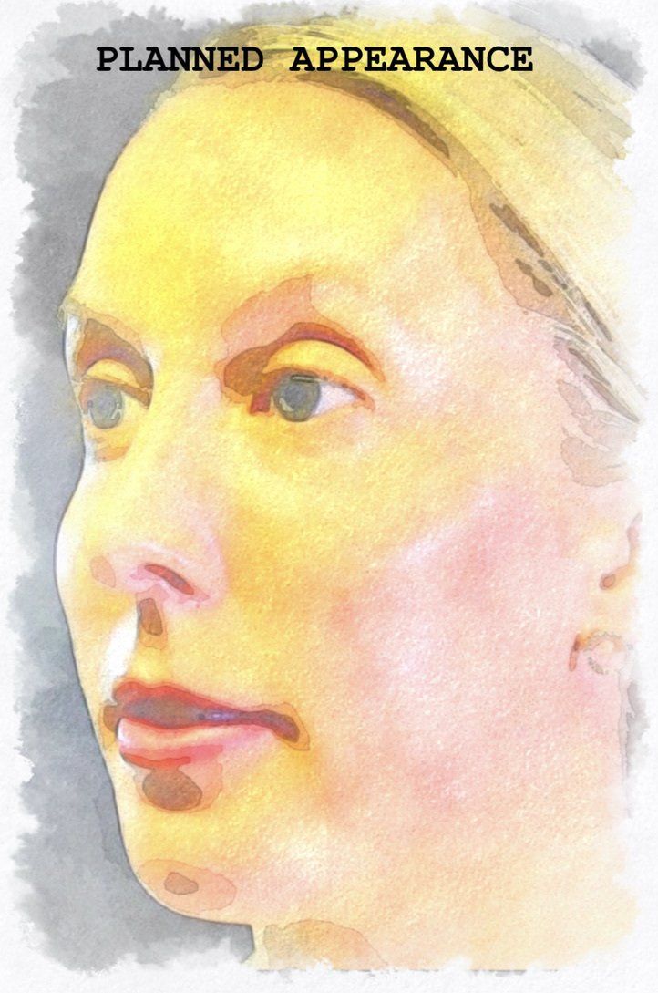 Case study of full face treatment by Dr Ruth Brady