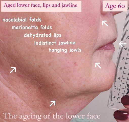 Aged Lower face Before PIcture Dr Ruth Brady