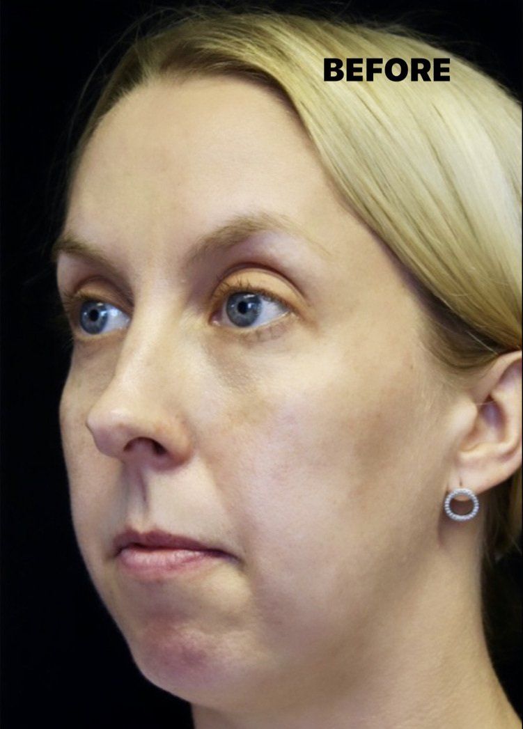 Case study of full face treatment by Dr Ruth Brady