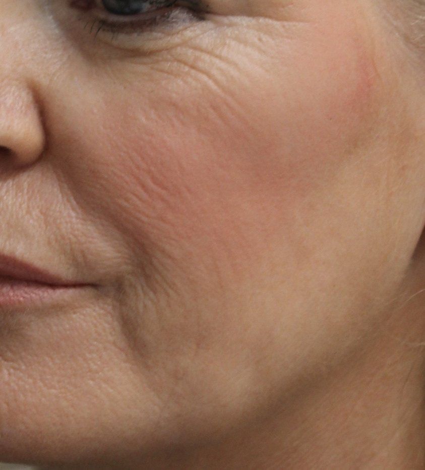 Cheek Augmentation Before PIcture Dr Ruth Brady