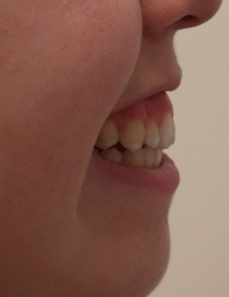 Gummy Smile Before Picture Dr Ruth Brady