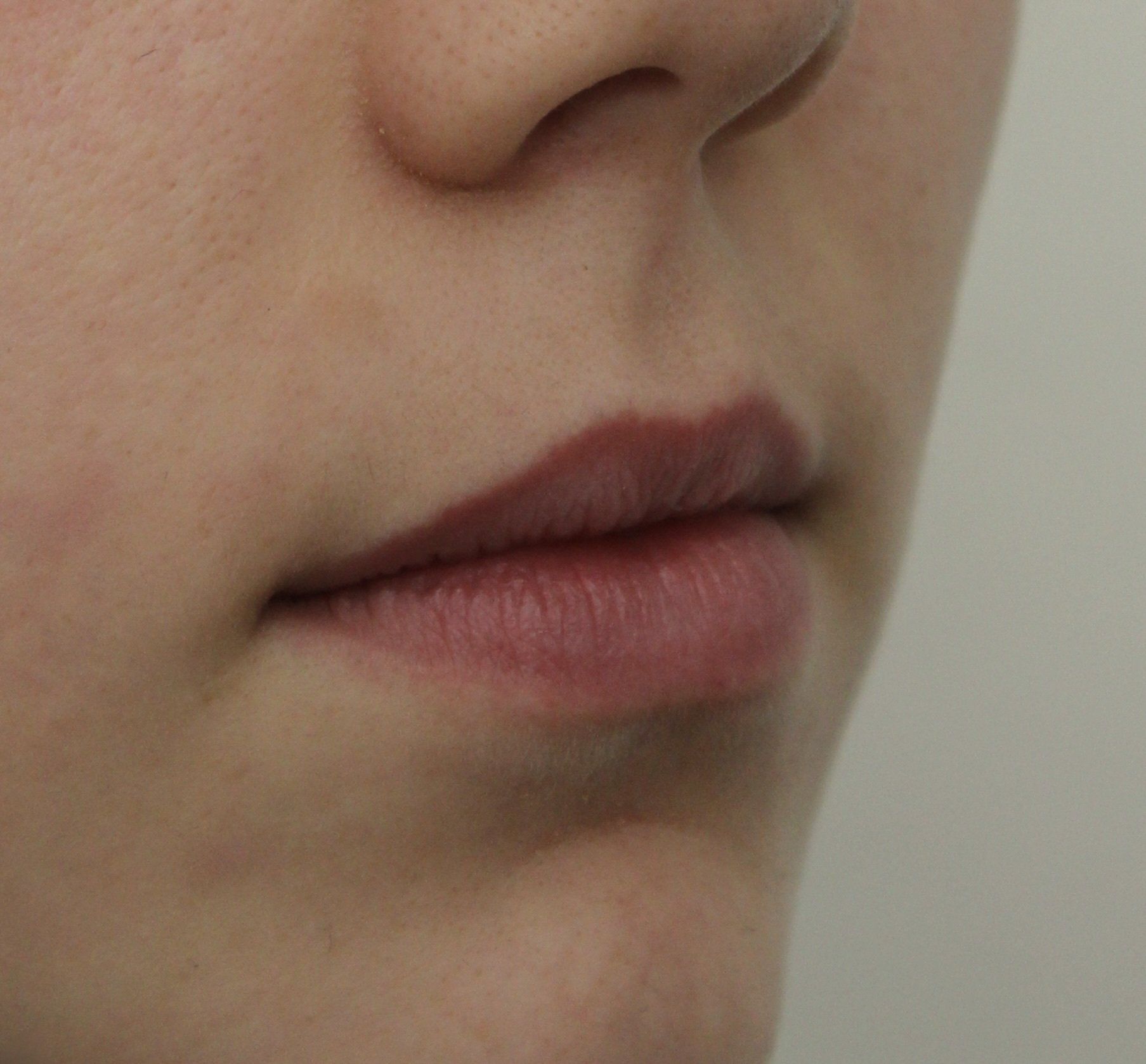 Lips Before PIcture Dr Ruth Brady