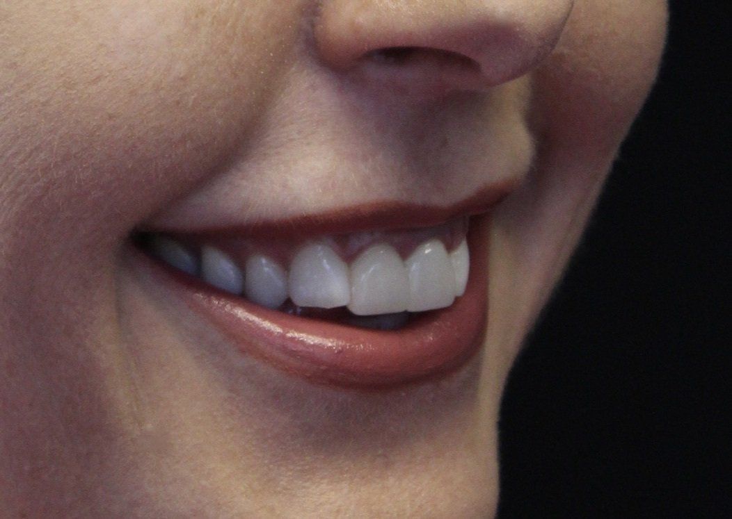 Gummy Smile After Picture Dr Ruth Brady