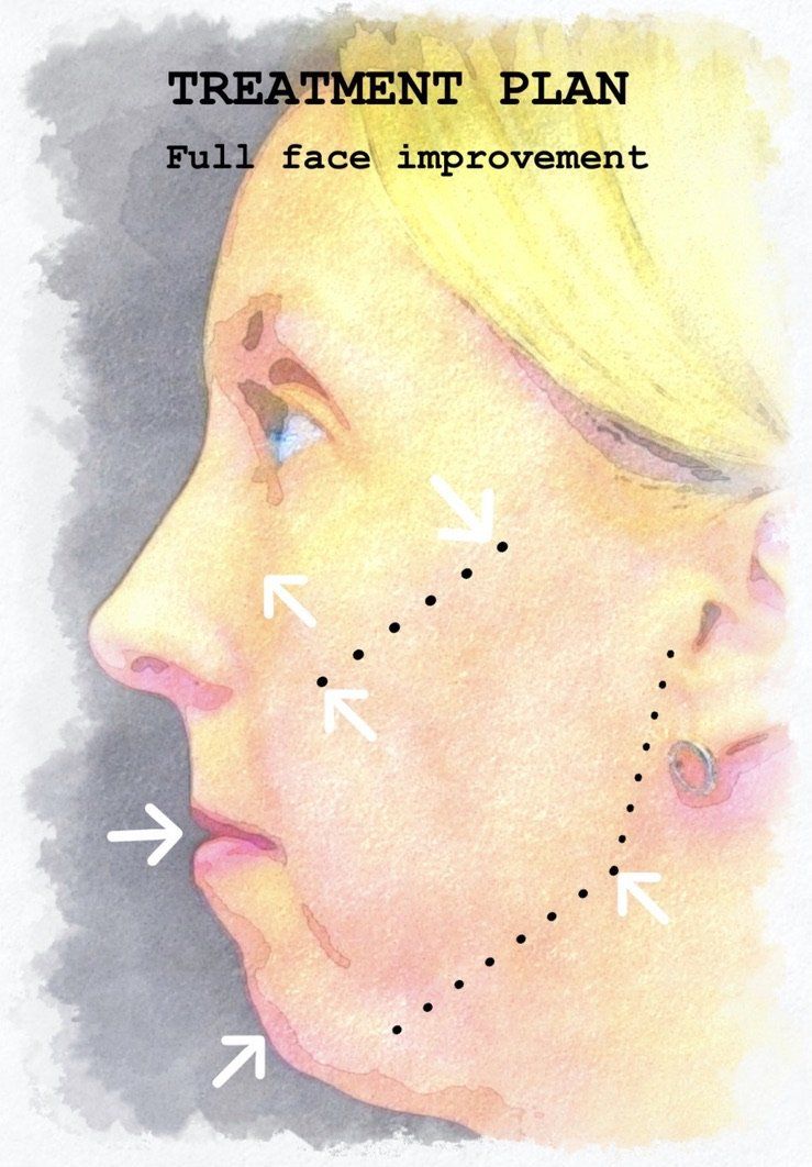 Case study of full face treatment by Dr Ruth Brady