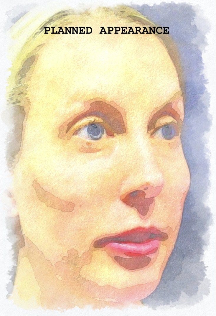 Case study of full face treatment by Dr Ruth Brady