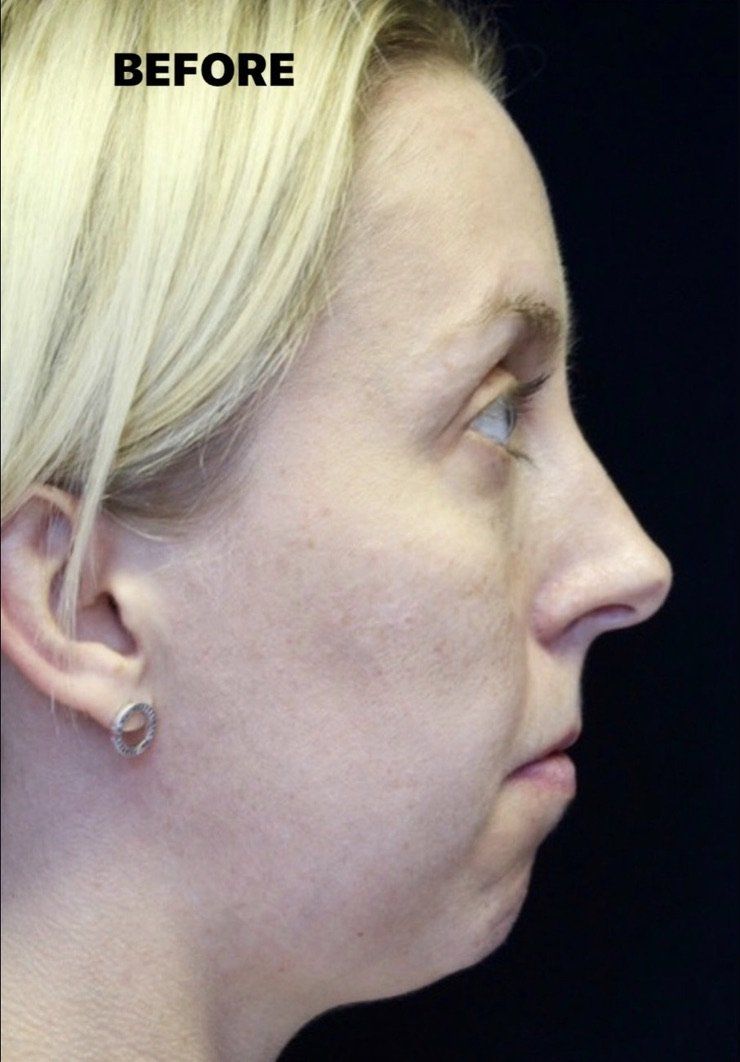 Case study of full face treatment by Dr Ruth Brady