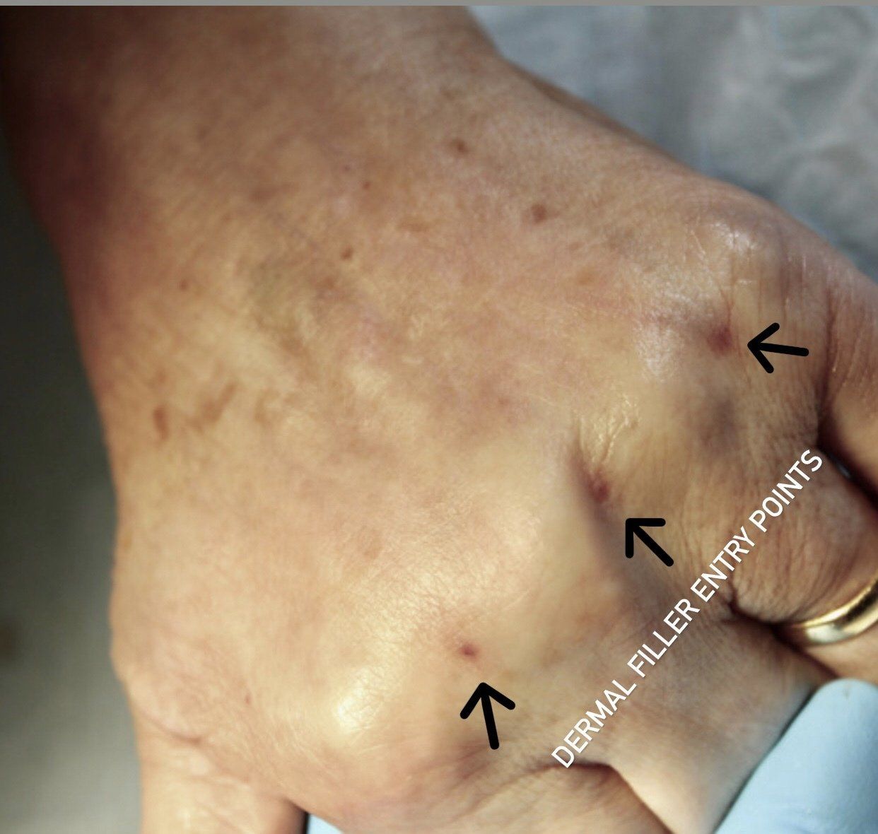 Picture of Hands Immediately after treatment