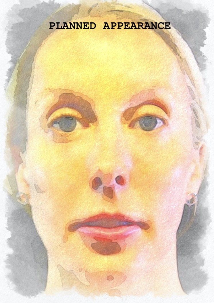 Case study of full face treatment by Dr Ruth Brady