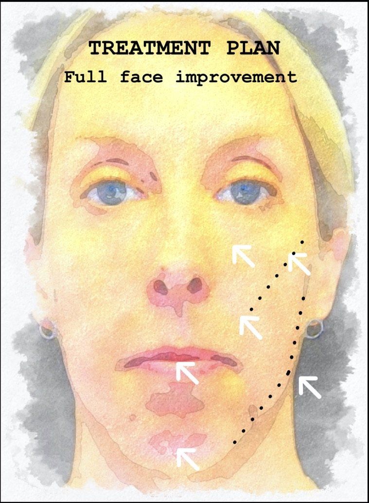Case study of full face treatment by Dr Ruth Brady