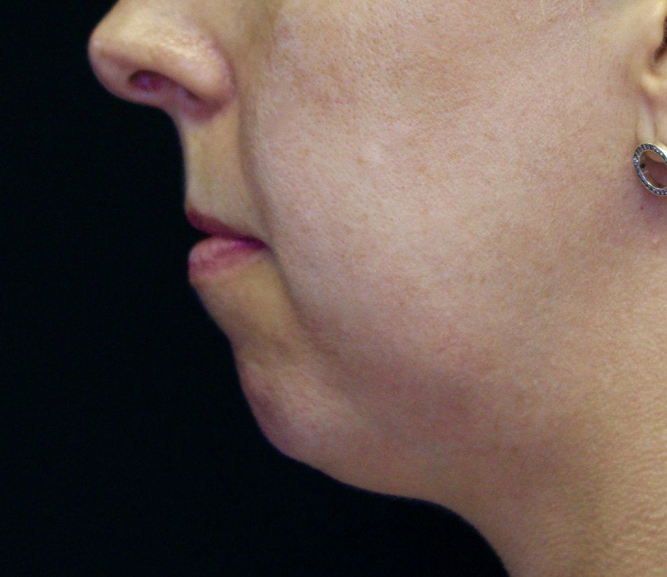 Chin Augmentation Before PIcture Dr Ruth Brady