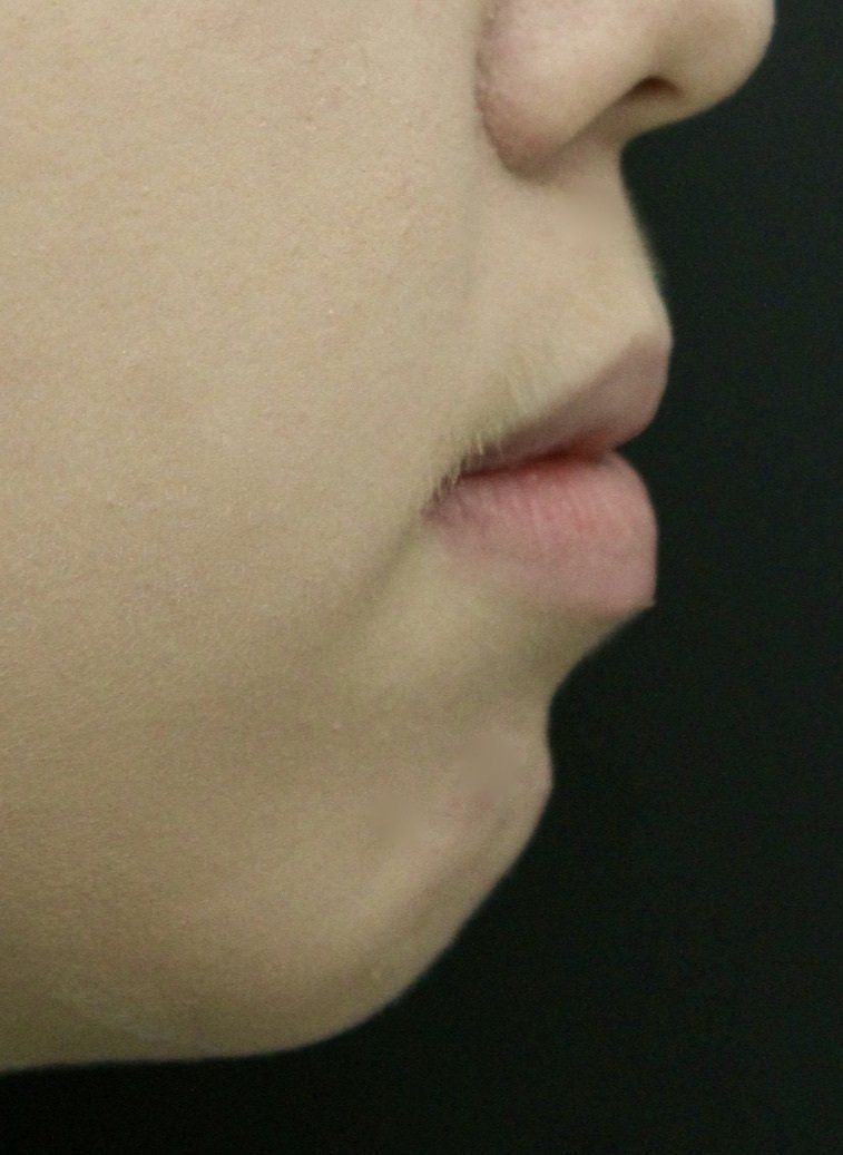 Chin Augmentation Before PIcture Dr Ruth Brady