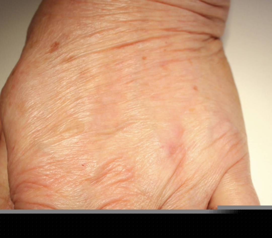 Picture of Hands a week after treatment