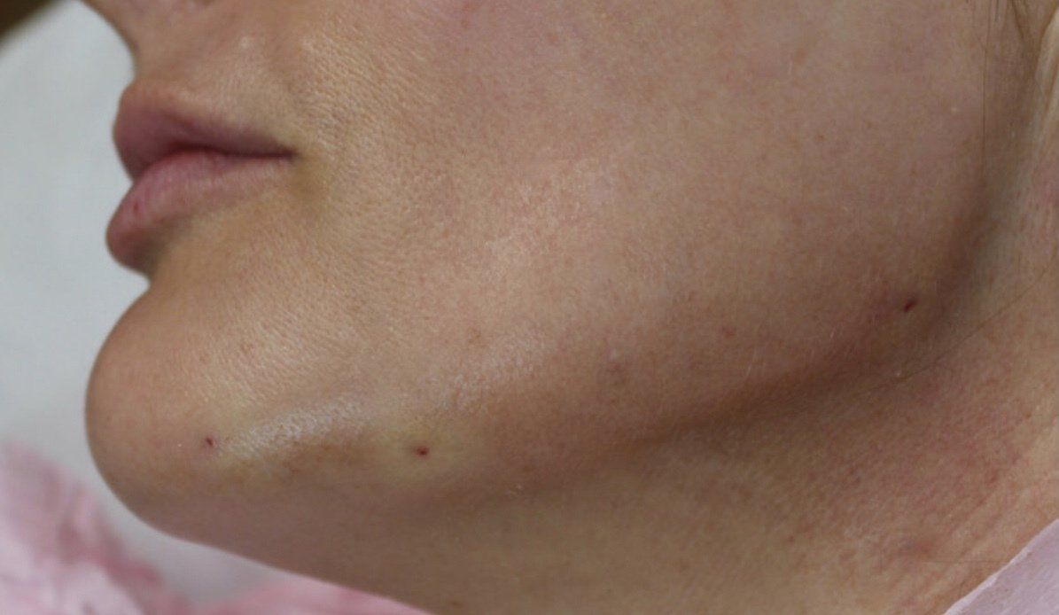 Picture of Lip Augmentation Corrected by Dr Ruth Brady