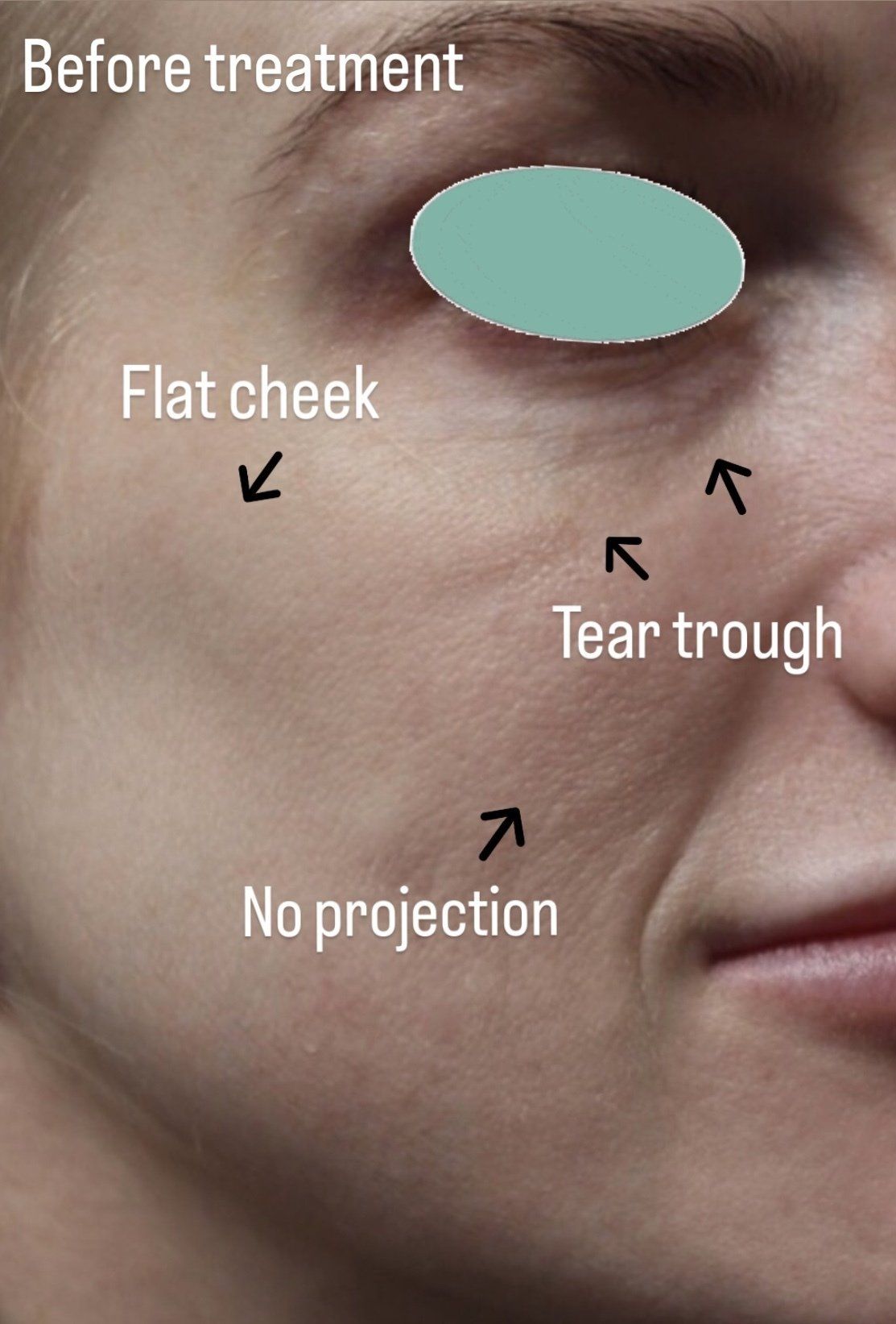 Cheek Augmentation Before PIcture Dr Ruth Brady