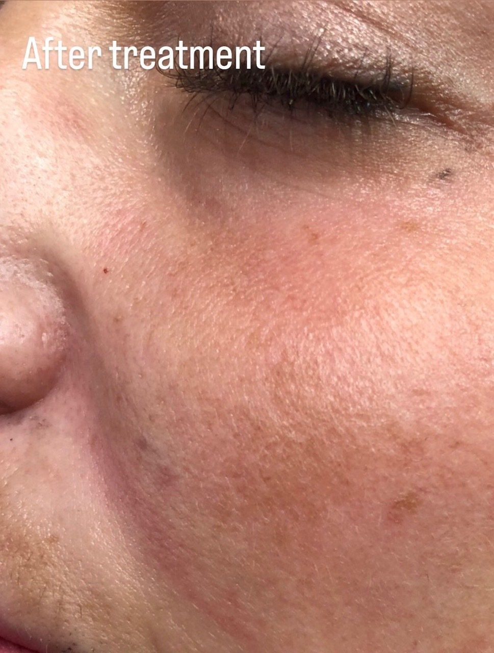 Picture of Cheek Corrected by Dr Ruth Brady