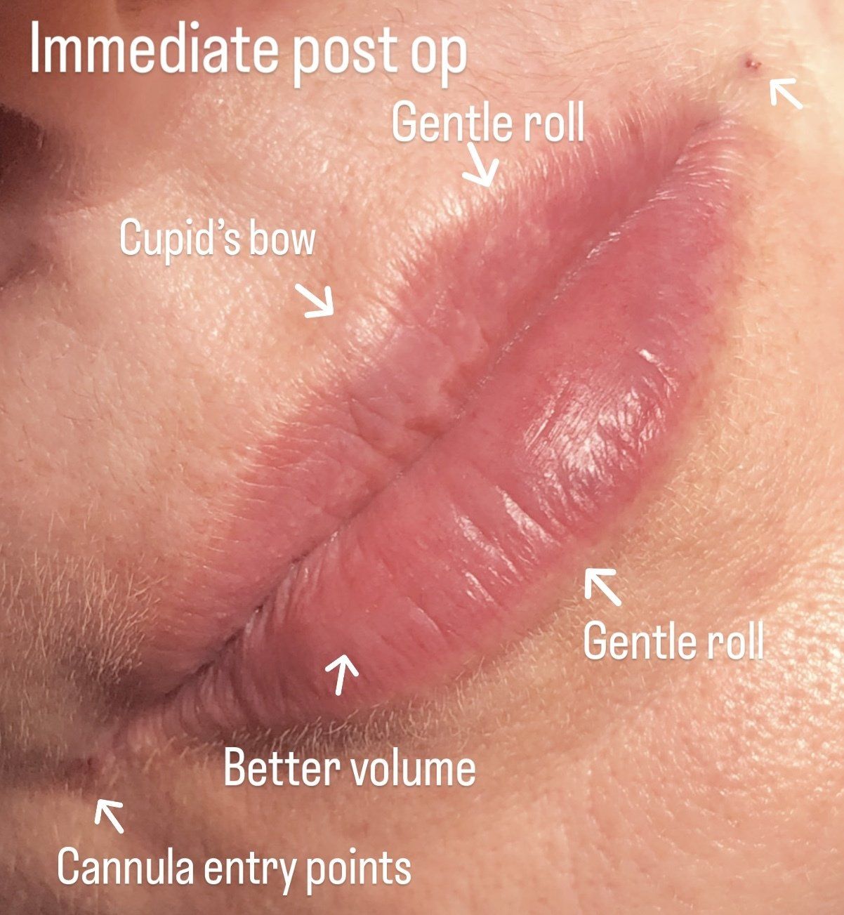 Picture of Cheek Corrected by Dr Ruth Brady