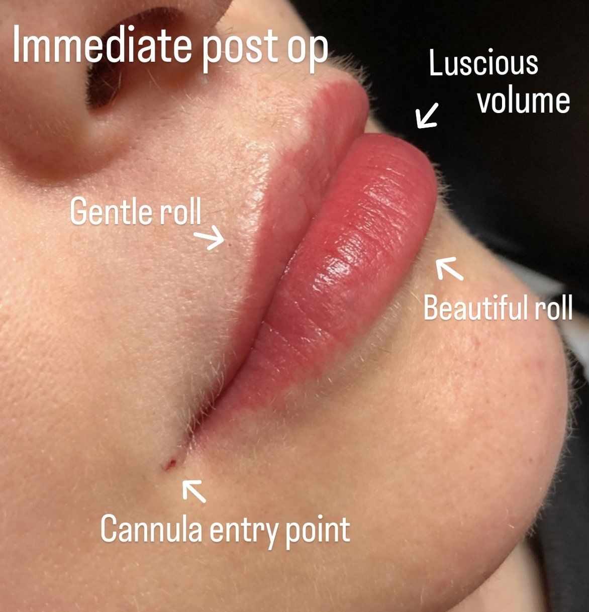 After Lip Treatment - Showing Enhanced Projection and Fullness