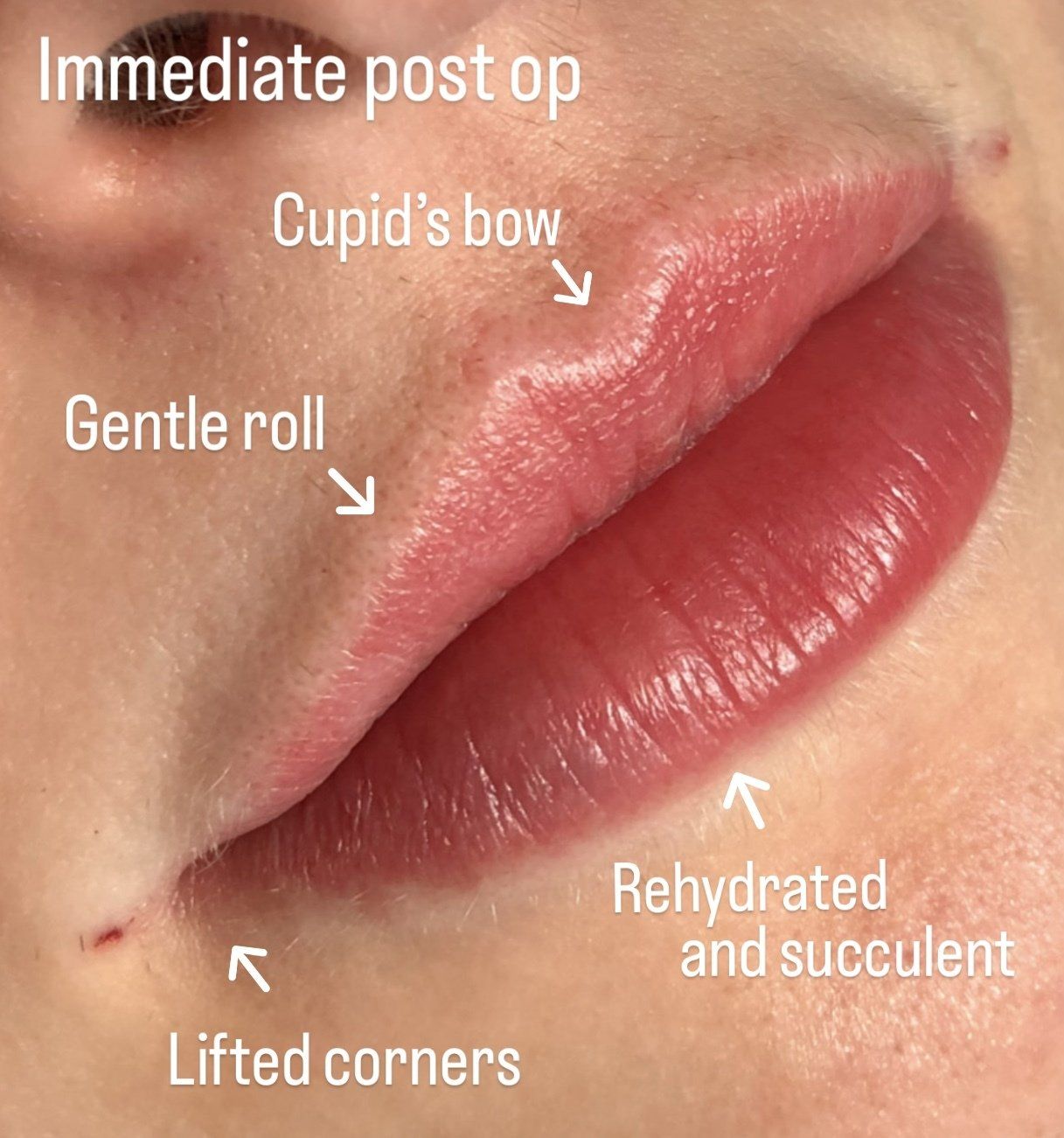 Picture of Cheek Corrected by Dr Ruth Brady