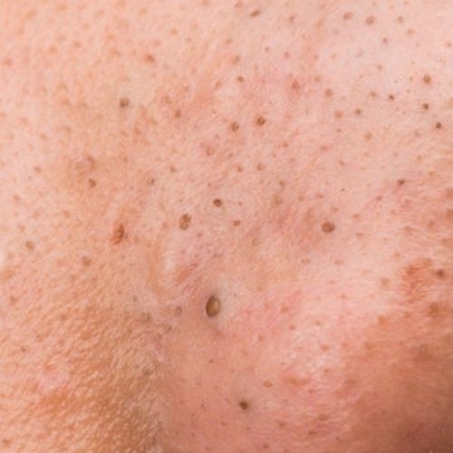 unreine haut hautproblem unreinehautberlin kosmetikberlin kosmetikstudioberlin kosmetikreinickendorf kosmetikstudioreinickendorf