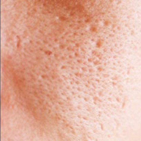 große poren hautproblem großeporenberlin hautproblemeberlin kosmetikberlin kosmetikstudioberlin kosmetikreinickendorf