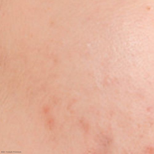 mischhaut im gesicht mischhautberlin kosmetikberlin kosmetikstudioberlin kosmetikreinickendorf kosmetikstudioreinickendorf