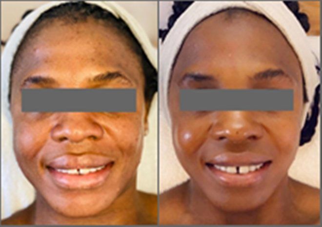 privat Unreine Haut Akne Hydrogen Peeling vorher nachher Kosmetik Kosmetiksalon Beauty Reinickendorf Wittenau Berlin