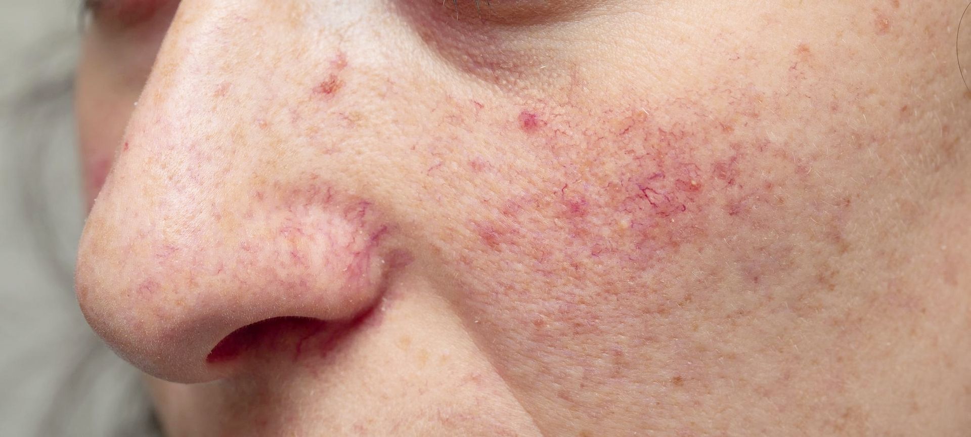 Freepik Premium rote äderchen im gesicht entfernen roteäderchenberlin couperoseberlin teleangiektasieberlin kosmetikstudioberlin kosmetikbehandlungenberlin gesichtbehandlungenberlin