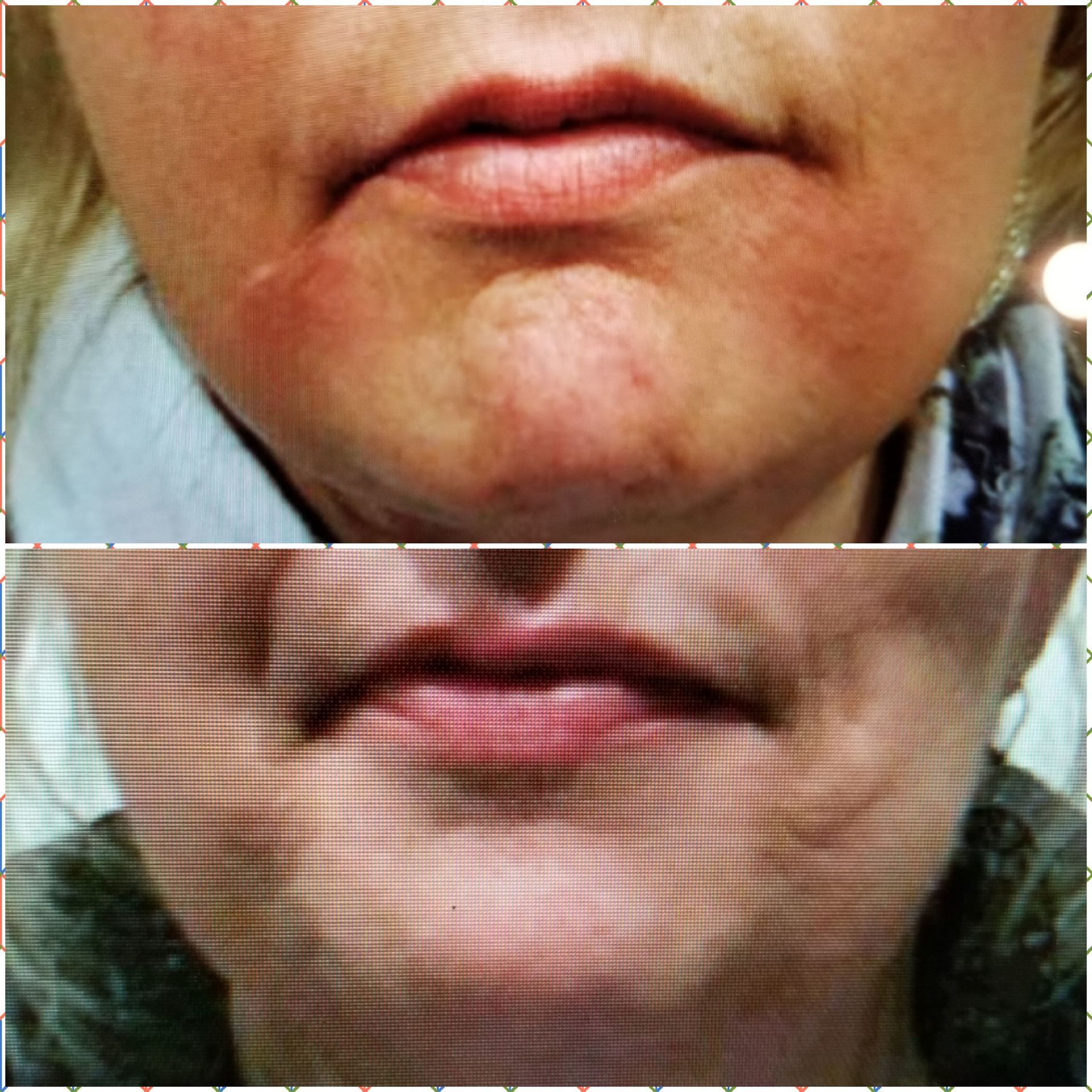 Below is before, Top is After Dermal Filler Radiesse Juvaderm Jowl Marionette lines antiaging wrinkles