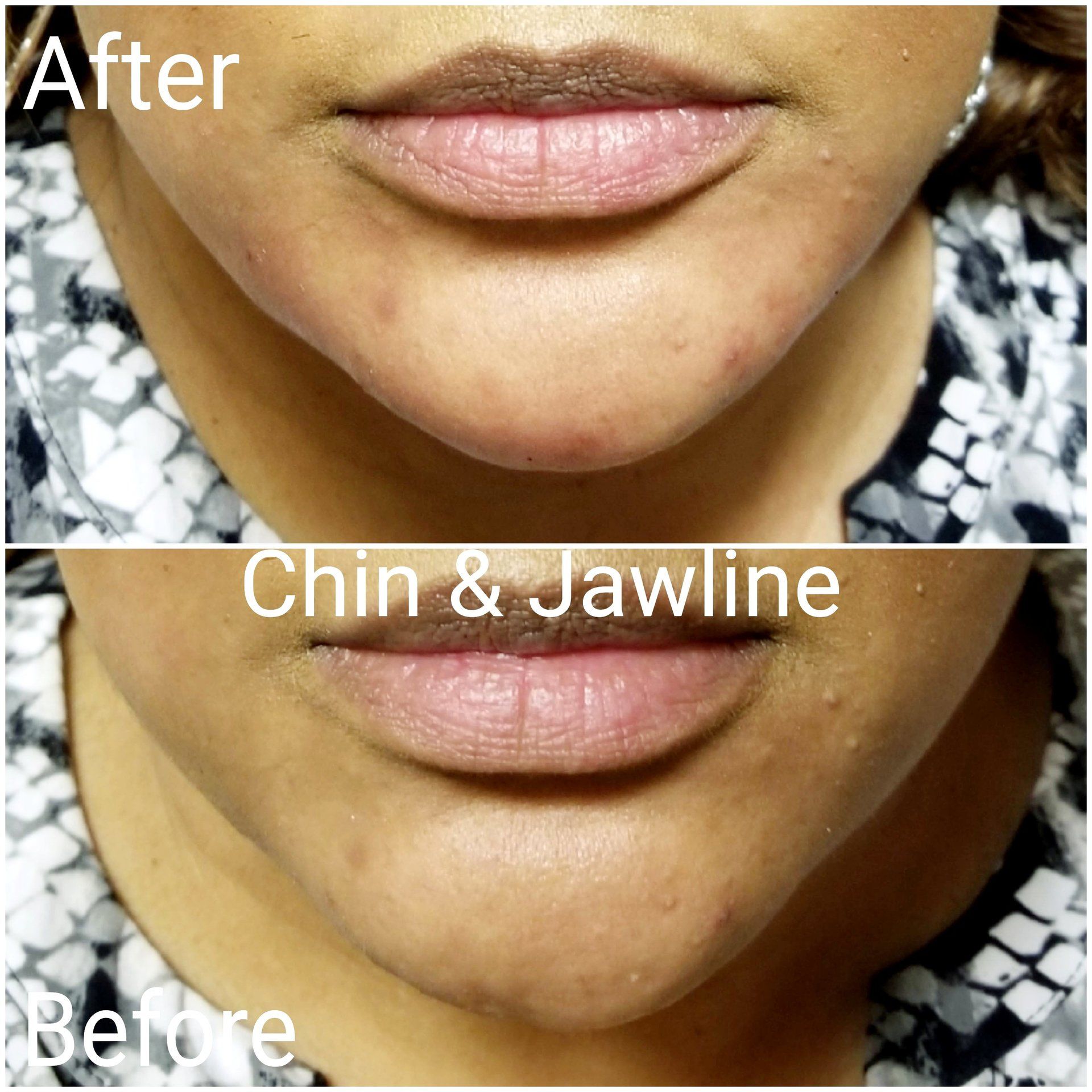 notice dent in chin was corrected with filler