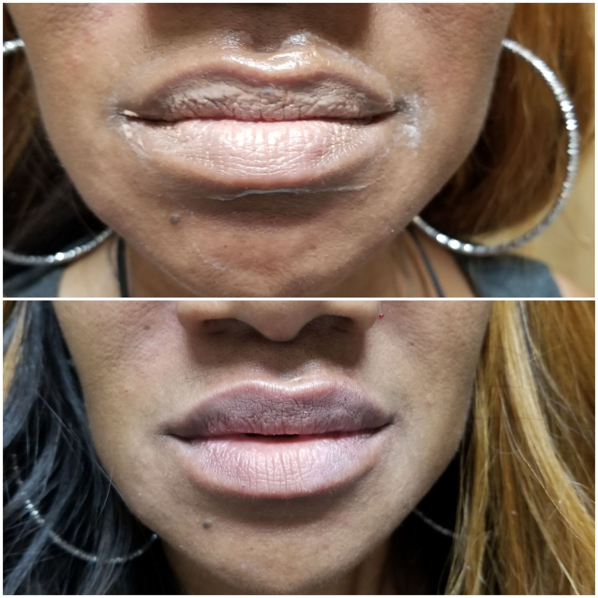 Top is before, Below is after Lip filler restylane juvaderm, plump lips Lip smoothing
