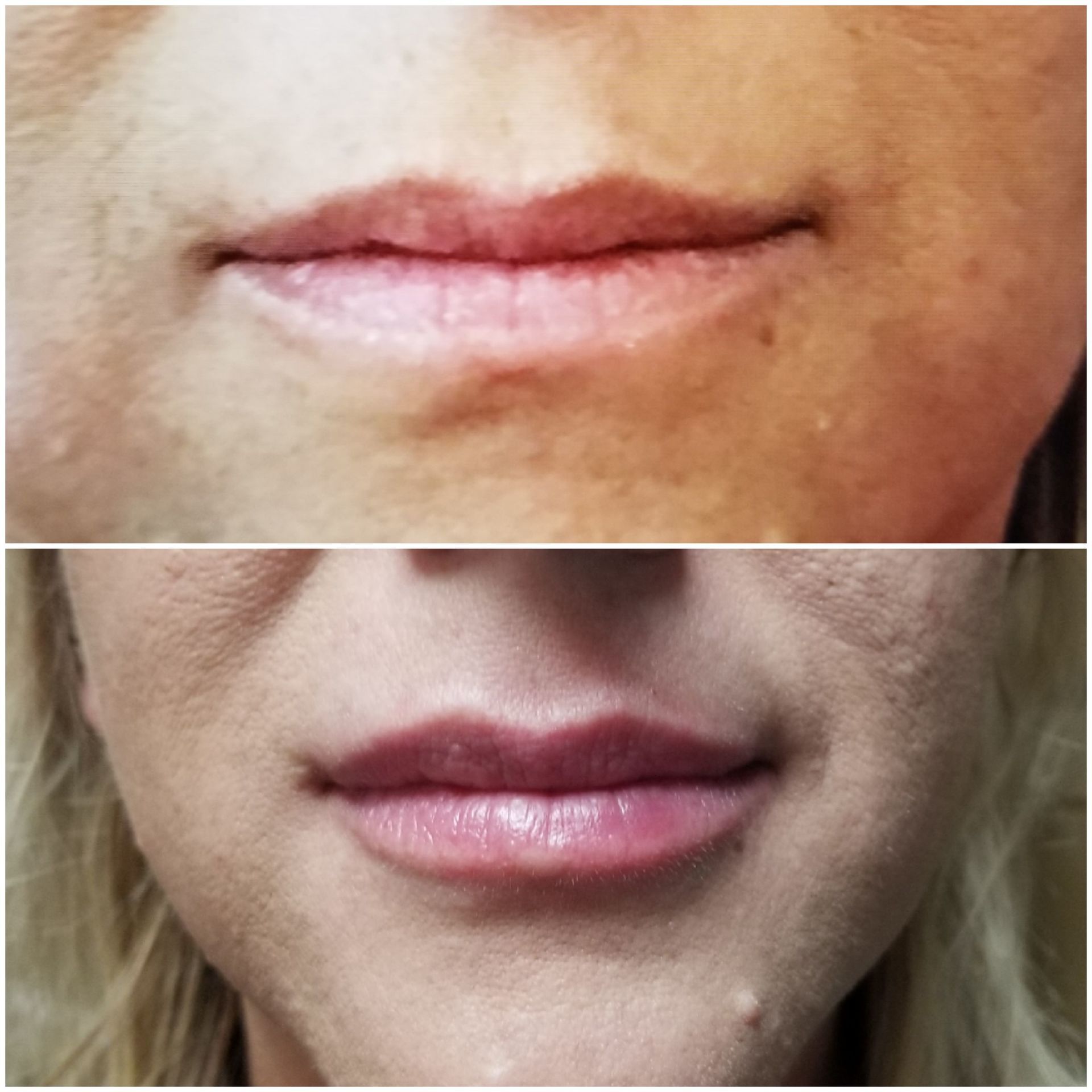 1 syringe restylane filler to lips lips plumpier fuller lips restylane juvaderm filler lip gloss lip pout
