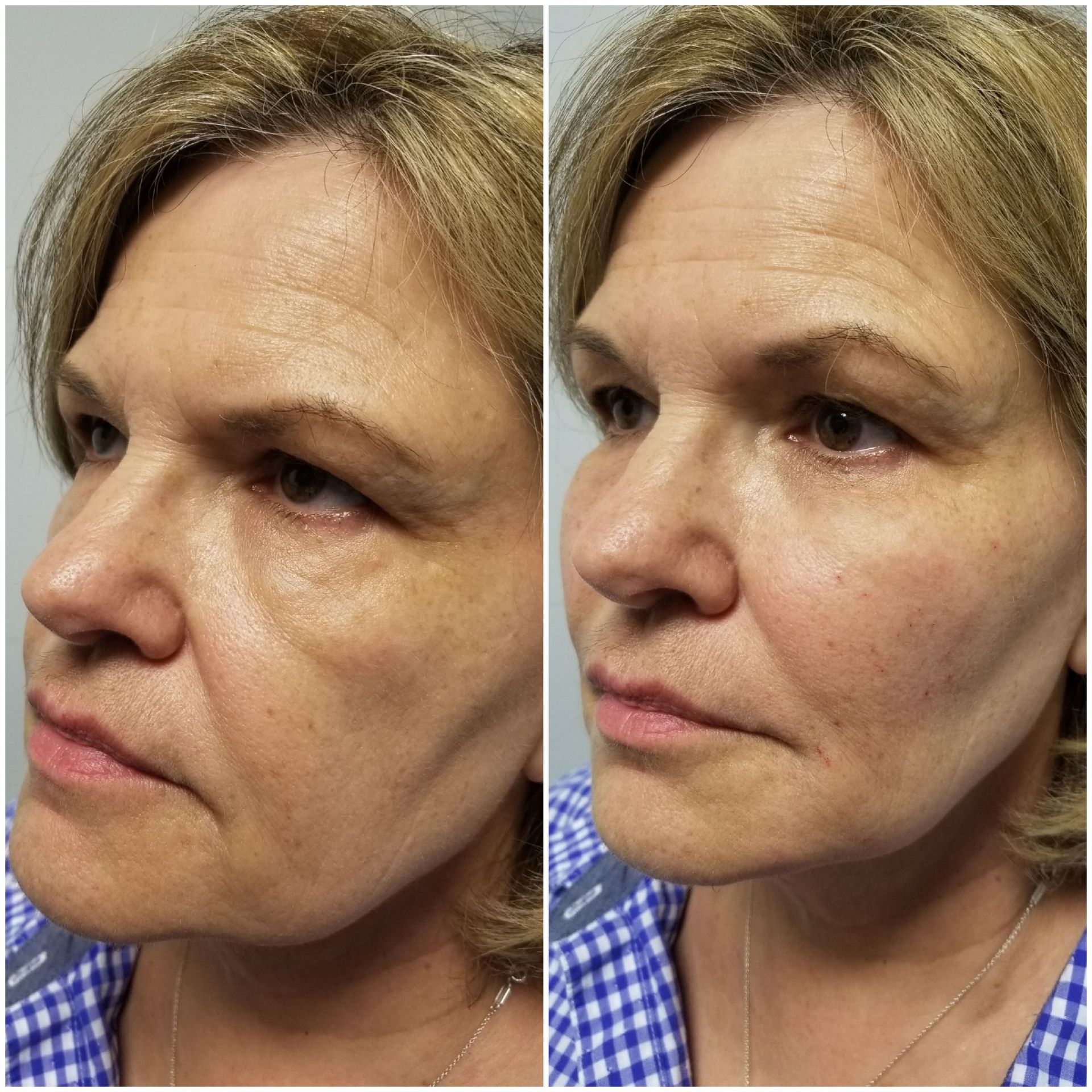 Cheek liquid facelift (before left, after right) Cheek mid facelife antiaging nonsurgical radiesse juvaderm voluma