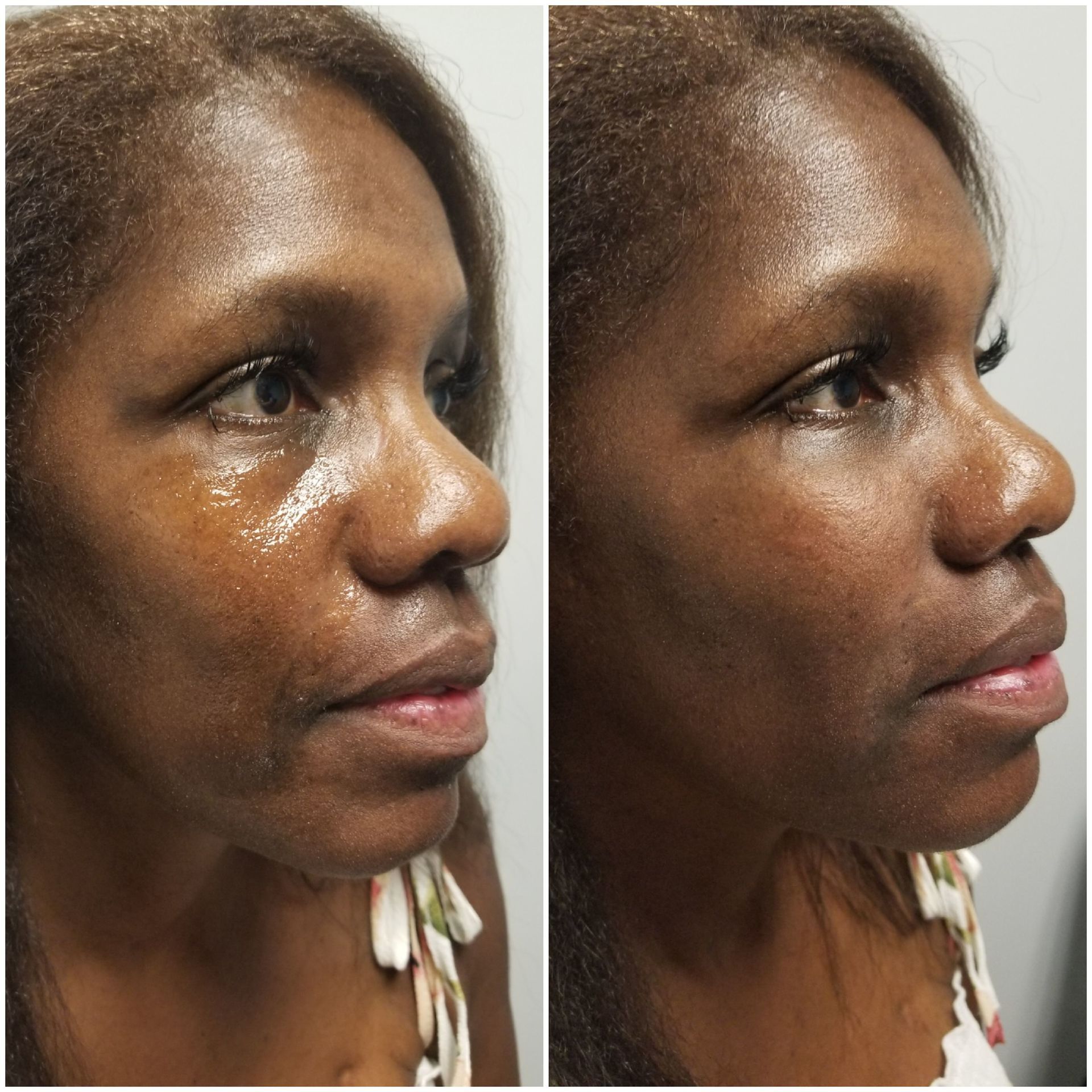 Undereye cheek filler (before left, after right) Cheek undereye filler restylane voluma radiesse juvaderm plastic surgery