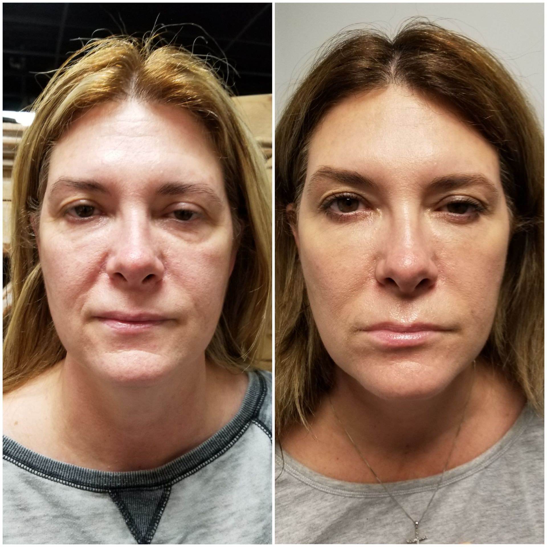 Filler to undereyes, cheeks, smile lines (before left, after right) Cheeks, undereyes, smile lines filler facelift radiesse restylane juvaderm