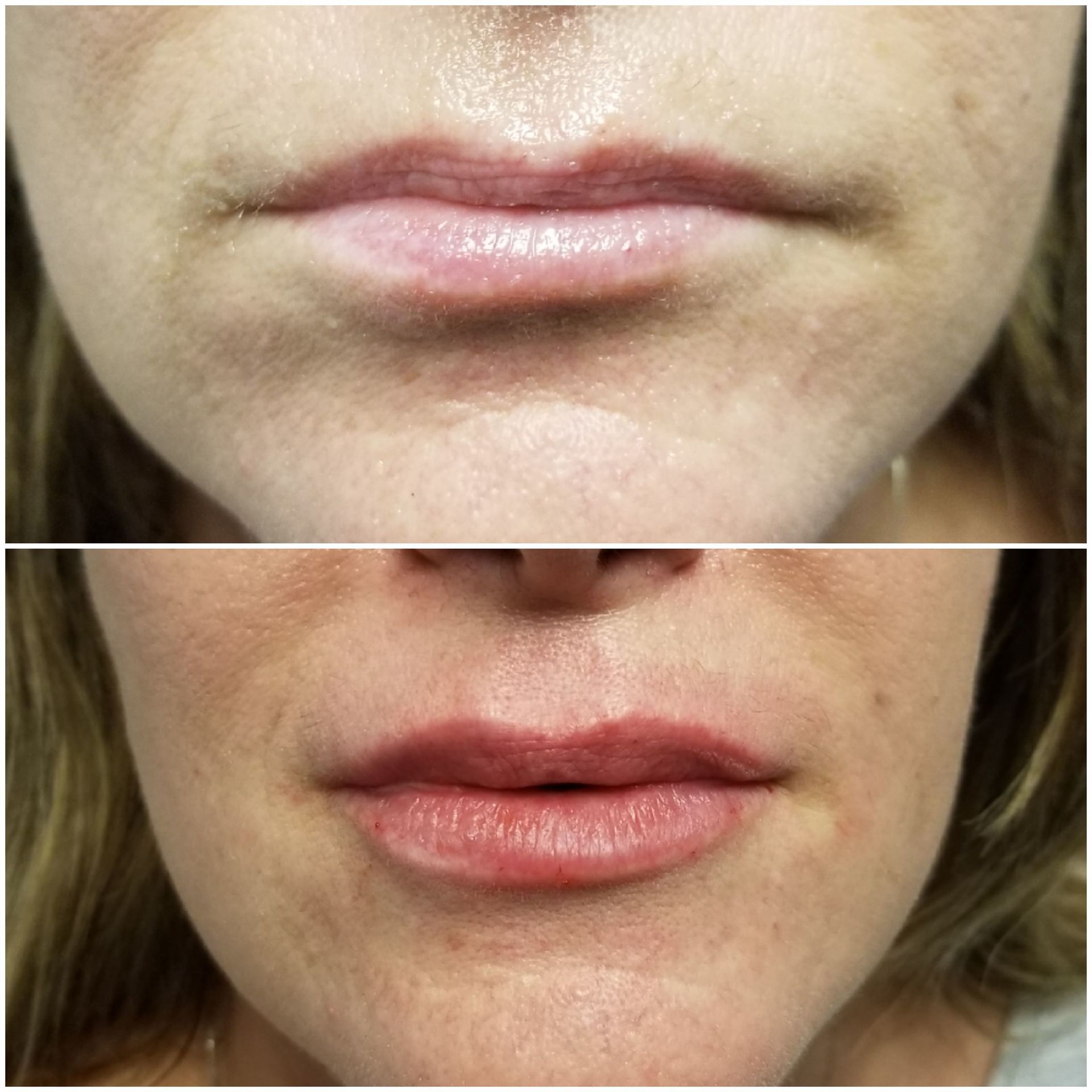 Lip Filler before top, after bottom lips before after photo filler injection restylane juvaderm