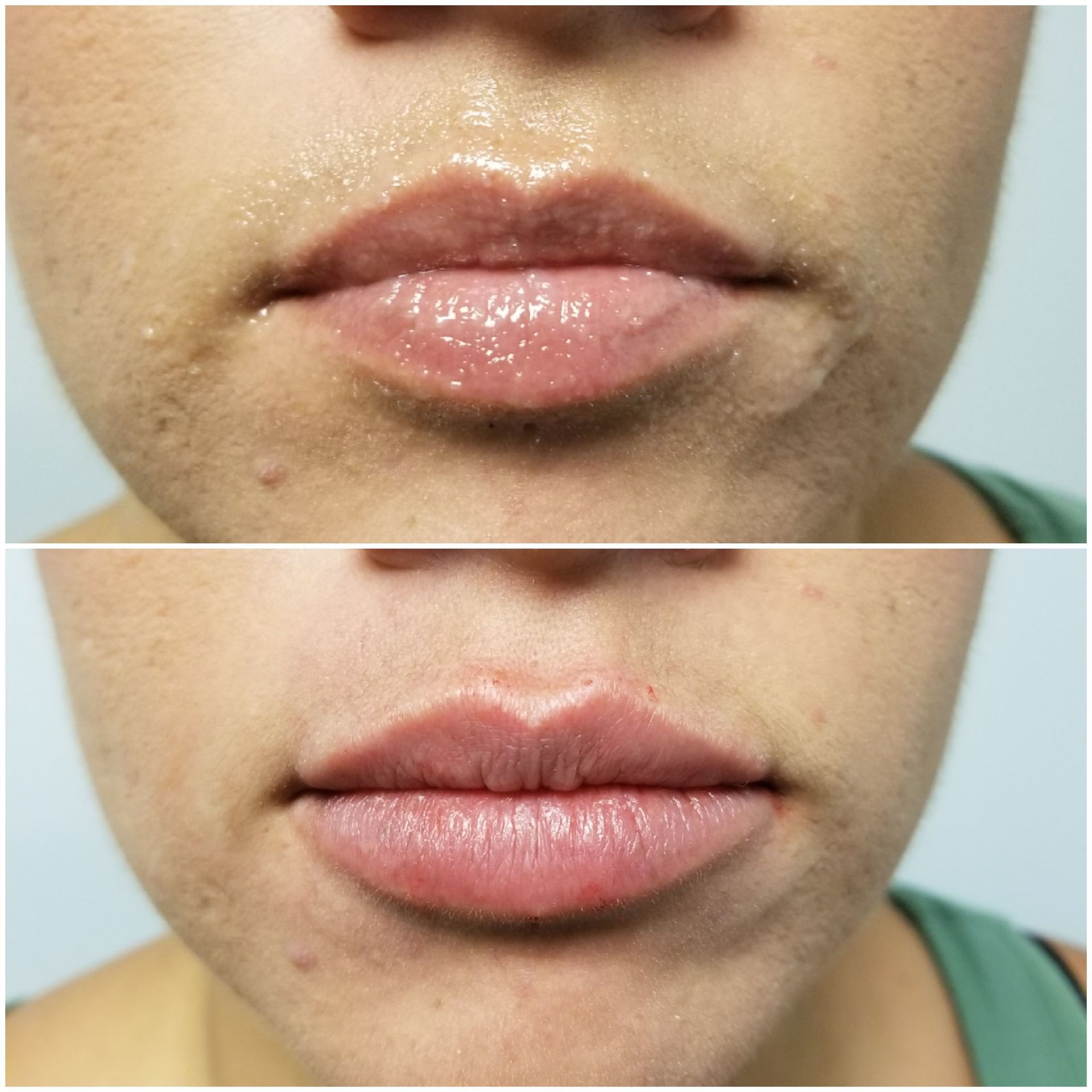 Lip filler before top, after bottom lip pout filler