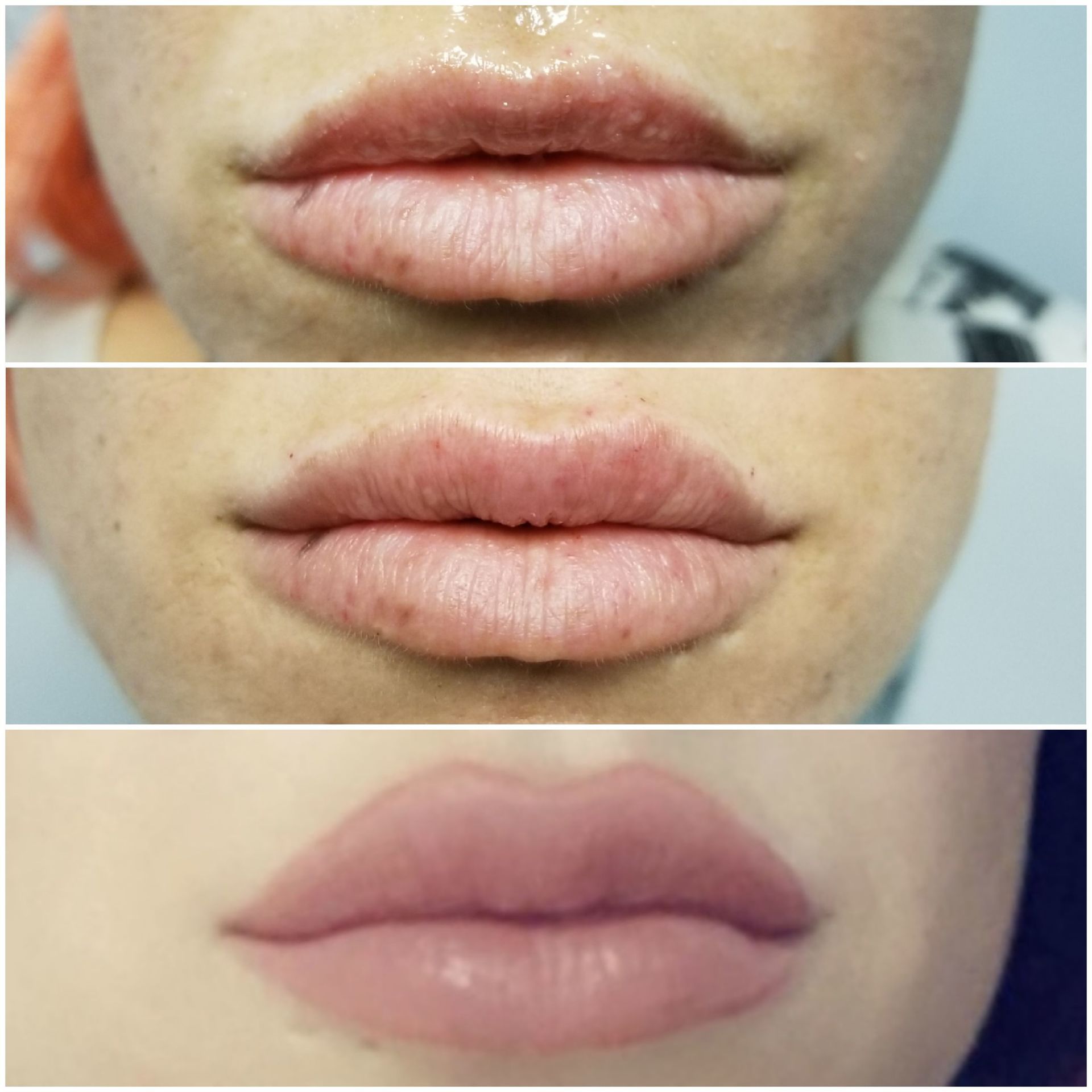 Lips pout filler fuller lips restylane versa juvaderm injections