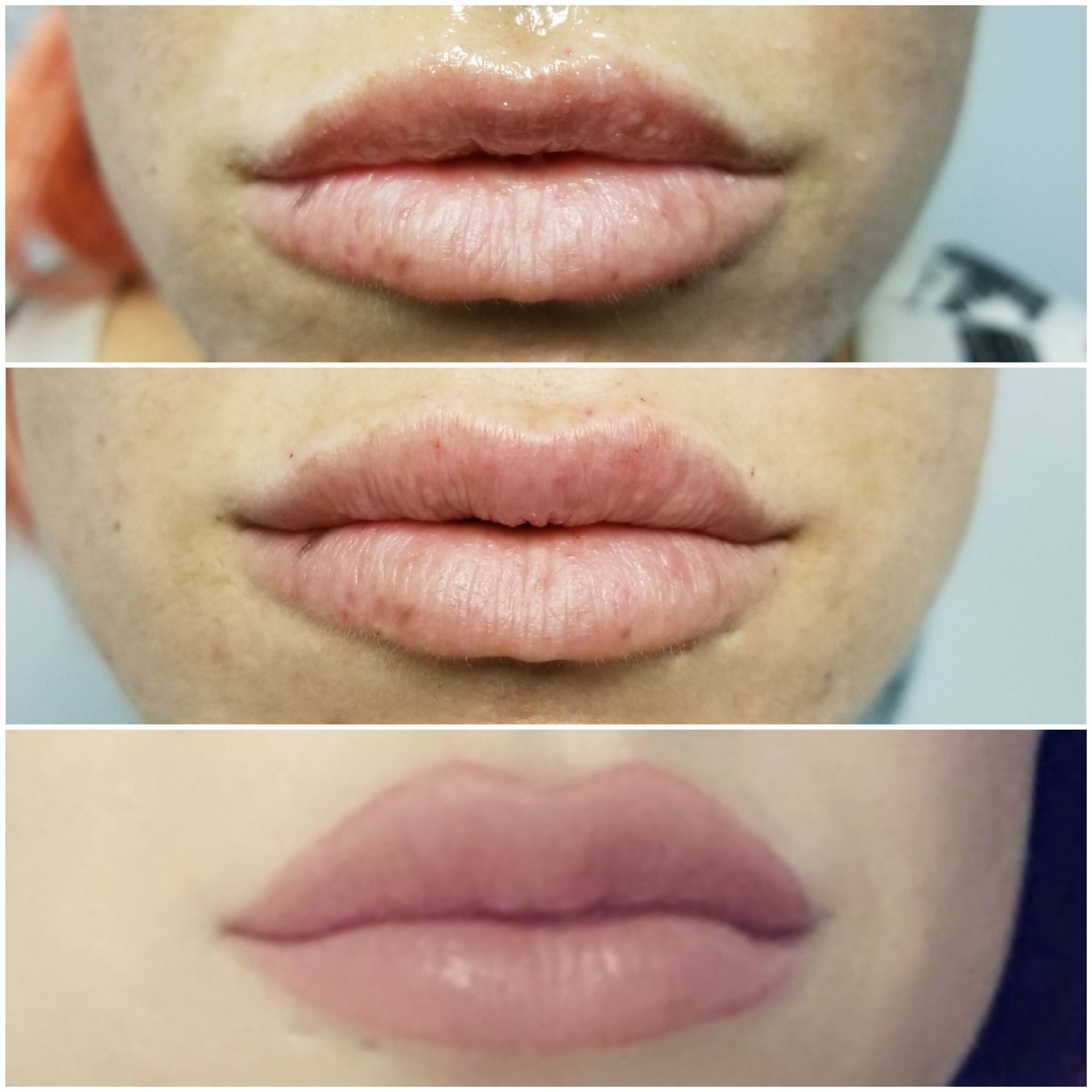 Upper lip filler only, before on top, after middle & bottom Lips pout filler fuller lips restylane versa juvaderm injections