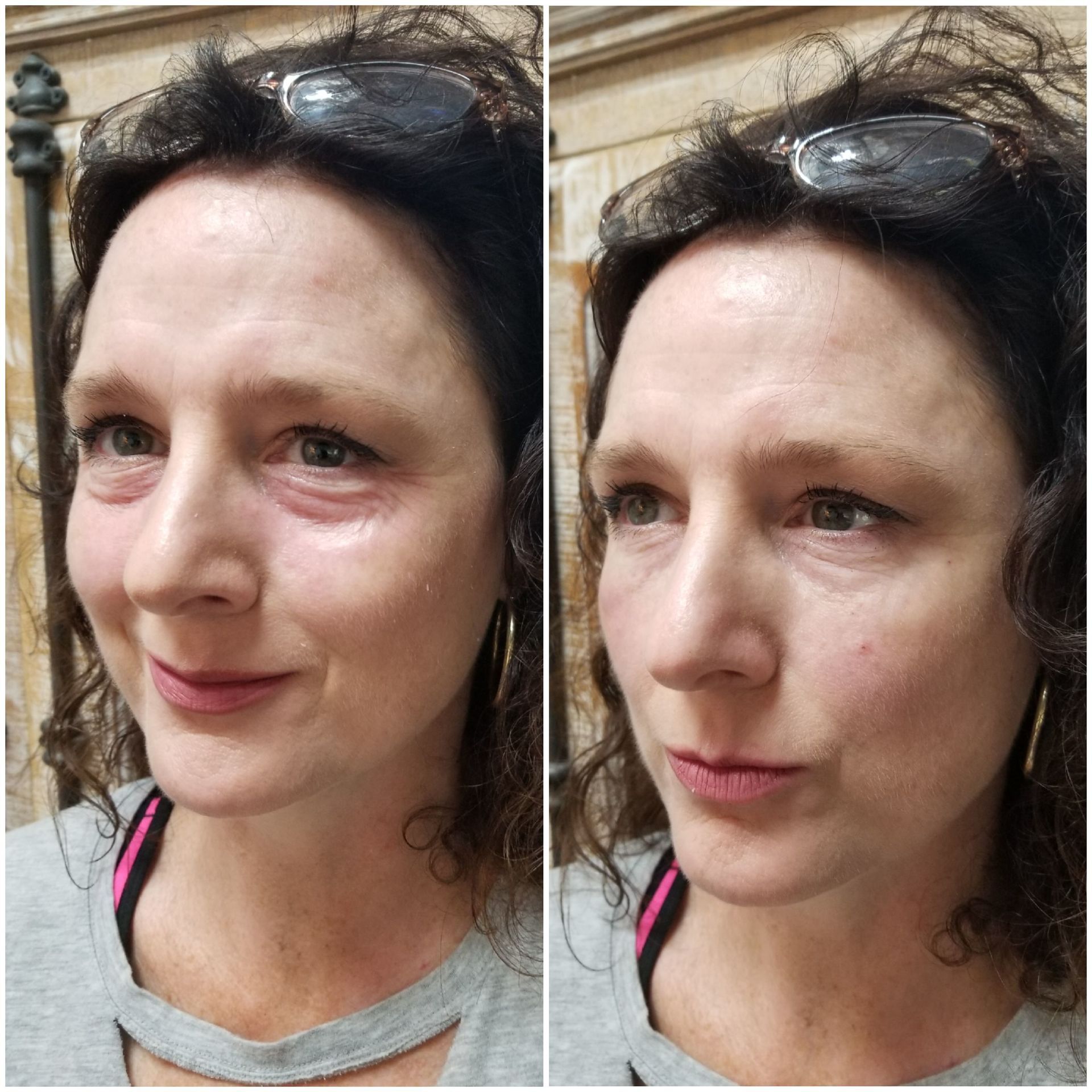 undereye filler (1 syringe) before left, after right undereye filler dark circles undereye hollows juvaderm restylane injection before after photos