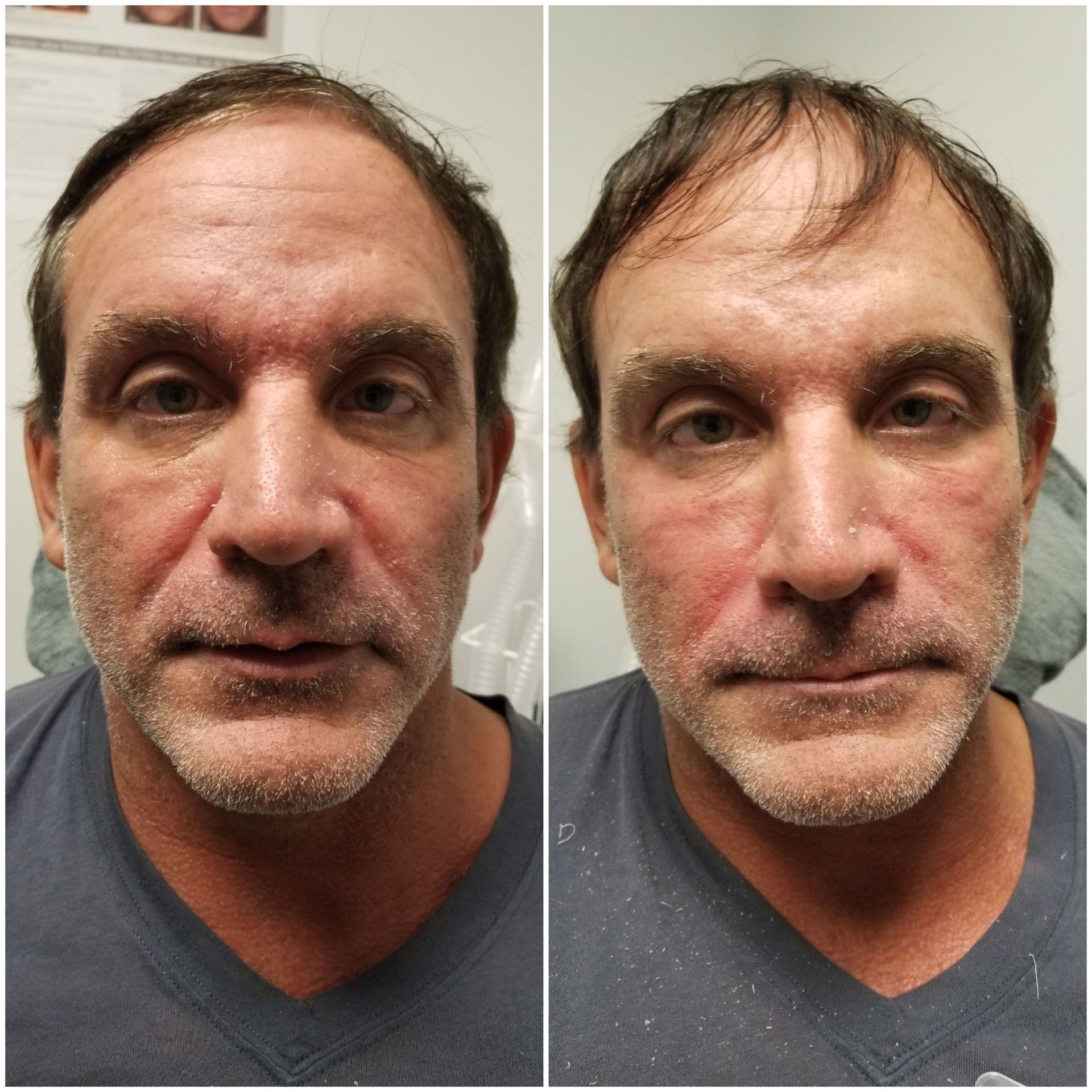 smile lines filler (before left, after right) smile lines nasolabial folds filler injection