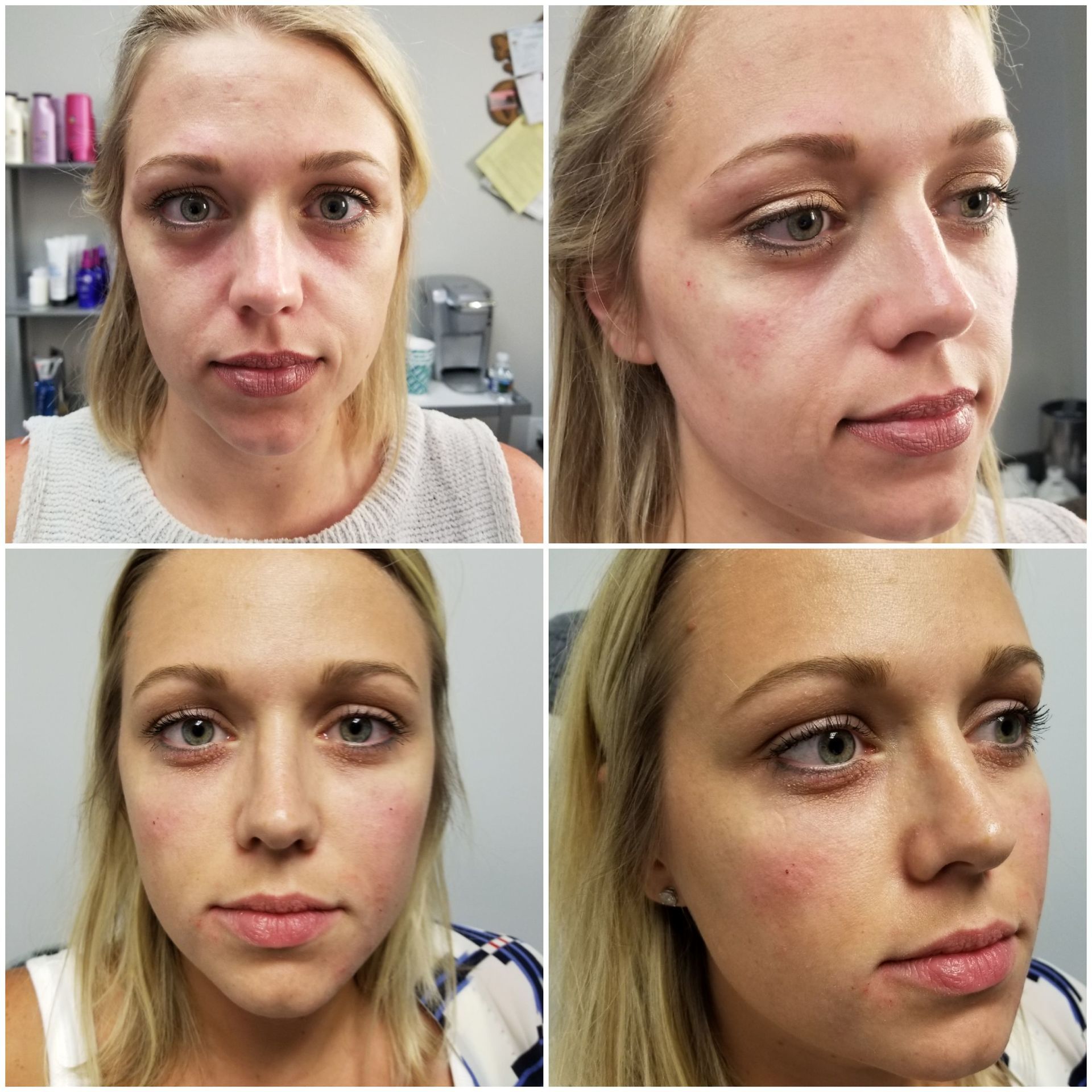 undereye cheek liquid facelift (before top, after bottom) facelift liquid filler injections undereyes dark circles cheek