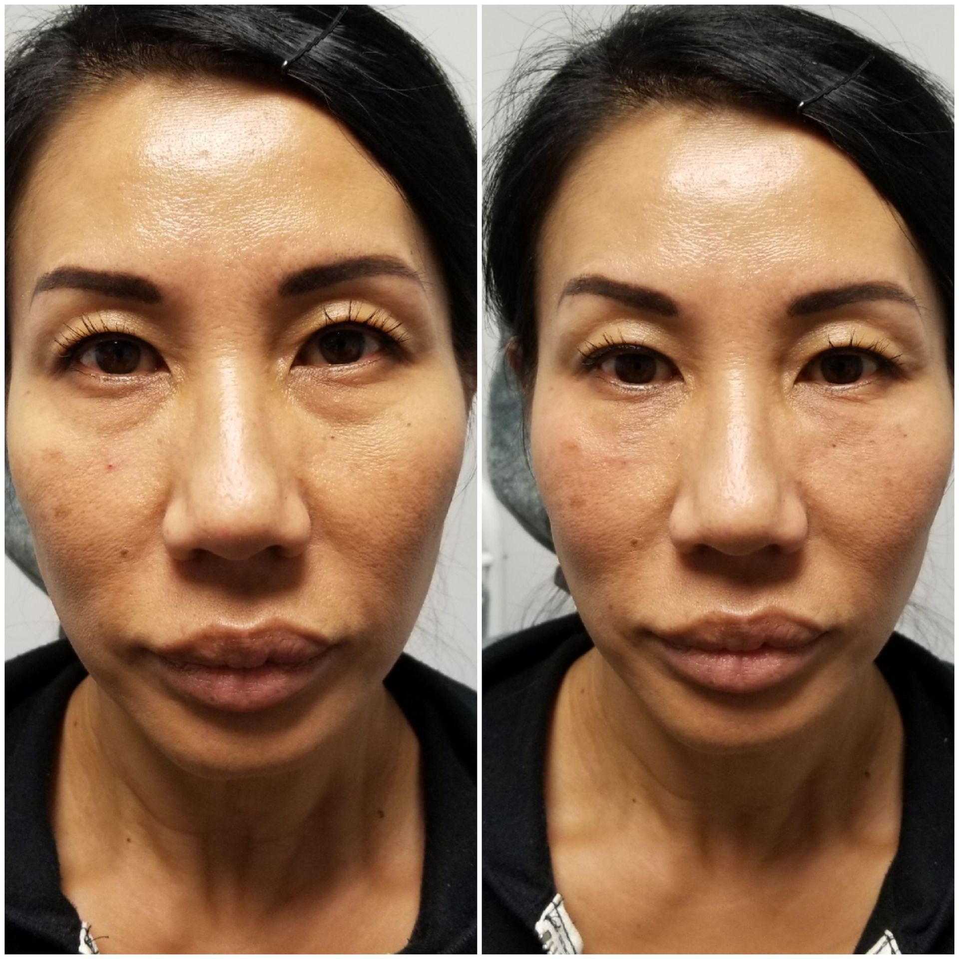 Undereye dark circles filler (before left, after right) undereye filler dark circles undereye hollows restylane juvaderm radiesse