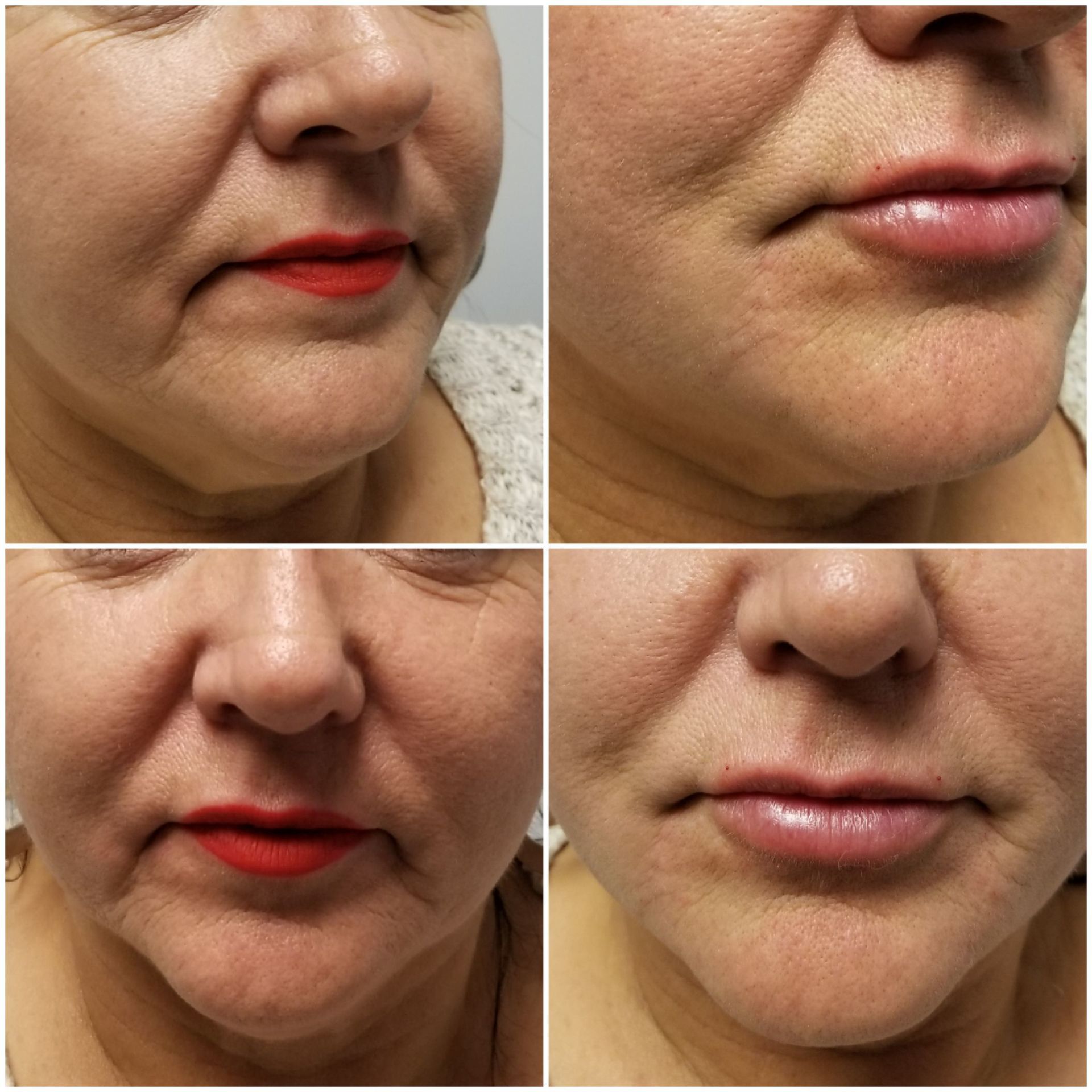 marionette lines on bottom jowl only radiesse (before left, after right) marionette lines filler injections before after jowls radiesse voluma juvaderm restylane facelift