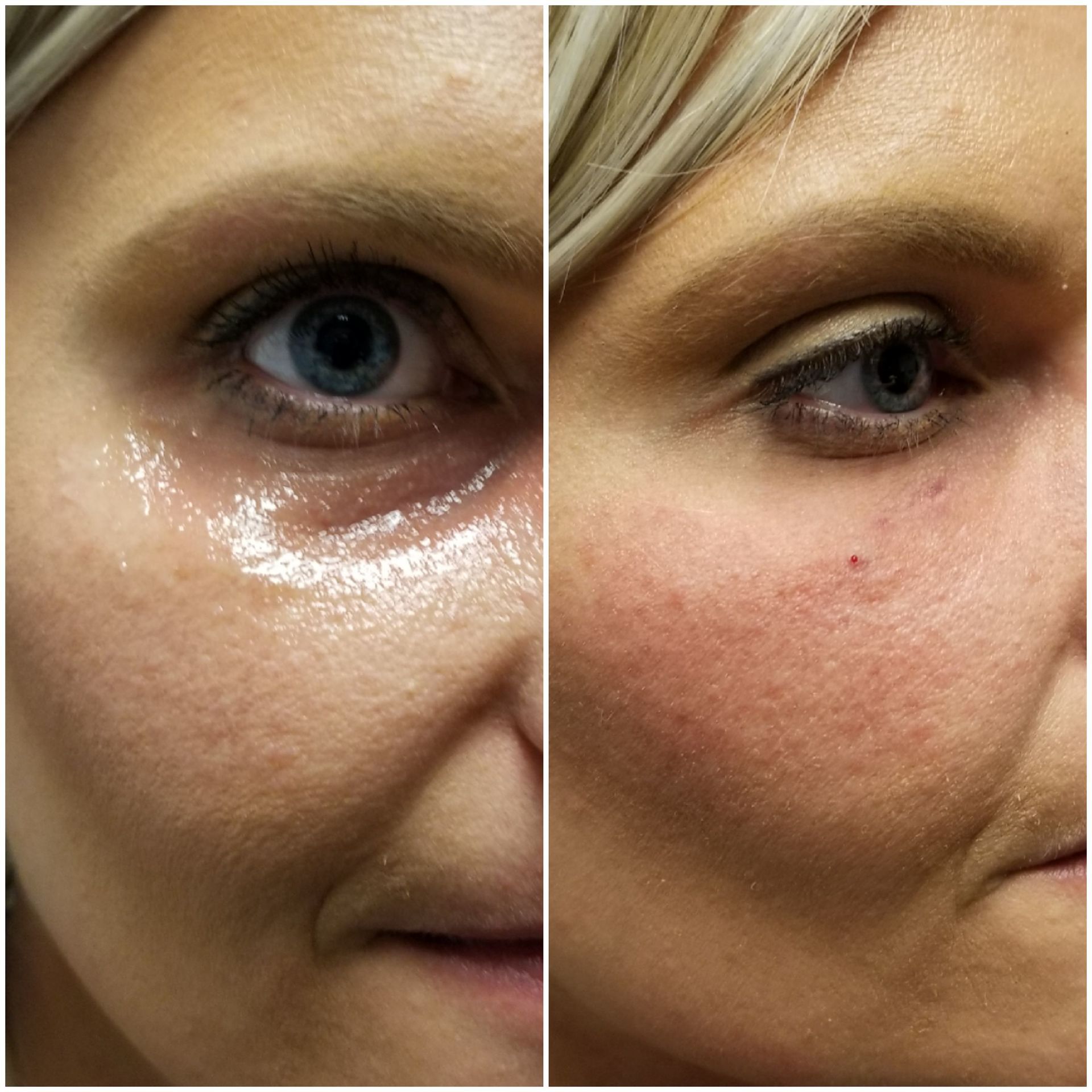 under eye circles filler injection voluma and restylane before left right after