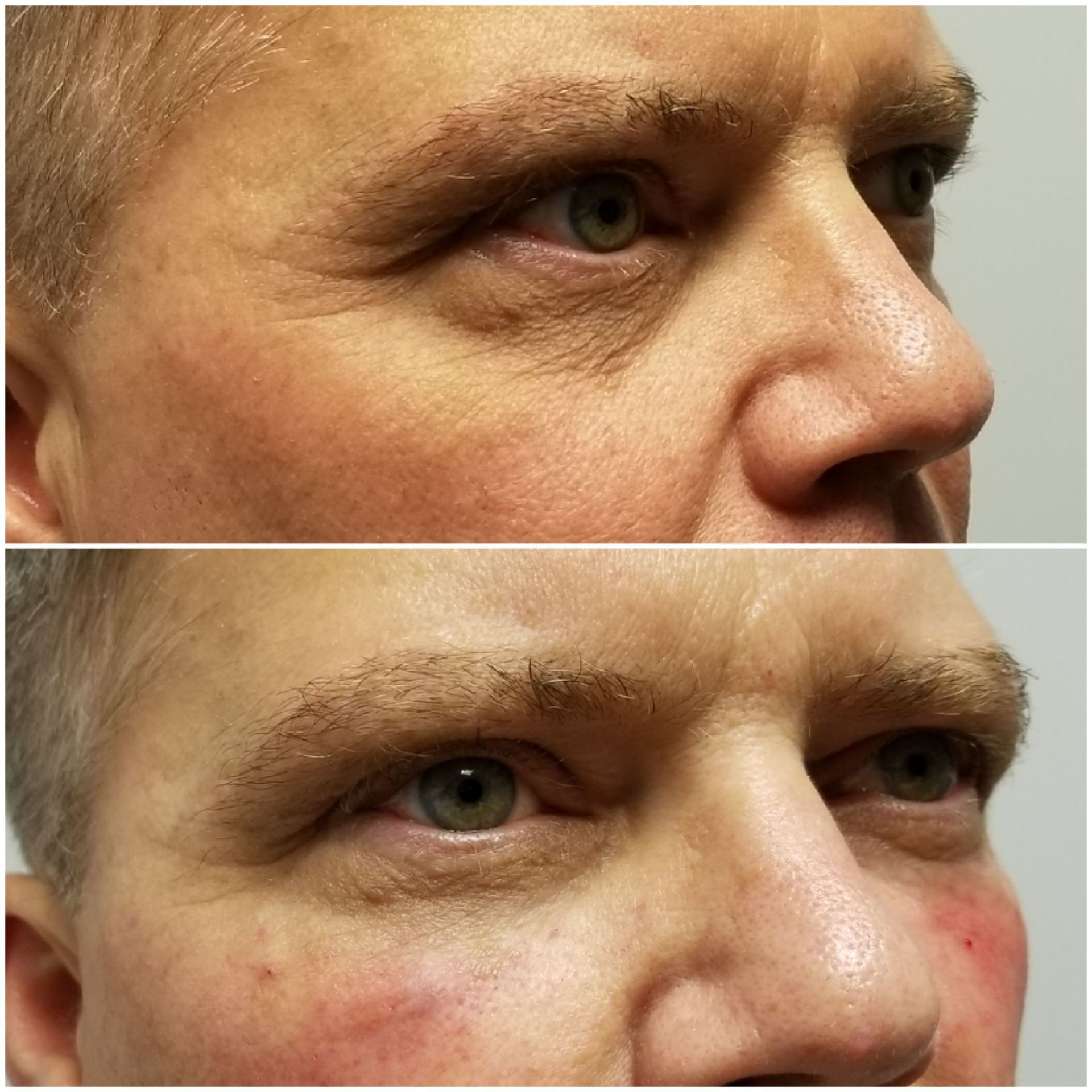 Undereye filler and cheek immediately after injection (before top, after right) undereye filler dark circles restylane juvaderm radiesse