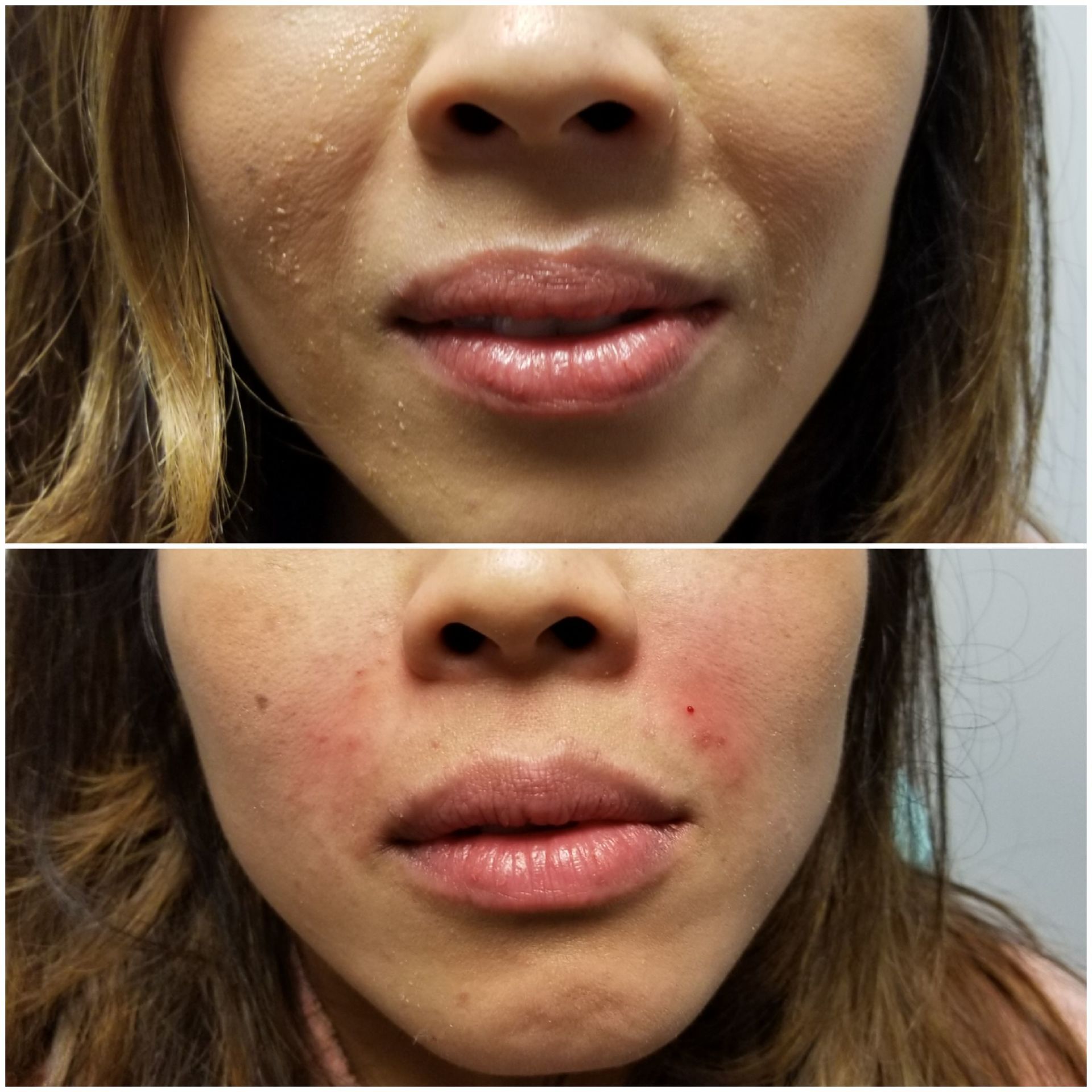 Smile Lines filler nasolabial folds (before on top, After on bottom) smile lines nasolabial folds filler restylane filler