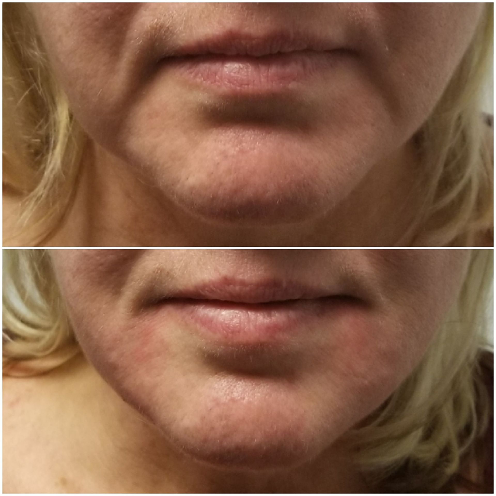 Marionette Lines, Jowls Before Top, After Bottom marionette lines, jowls restylane radiesse