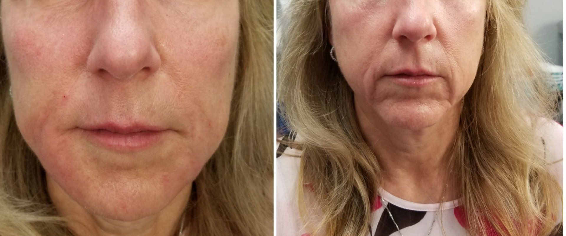 Jowls & Marionette lines before on right, after on left Marionette lines jowls radiesse restylane juvaderm