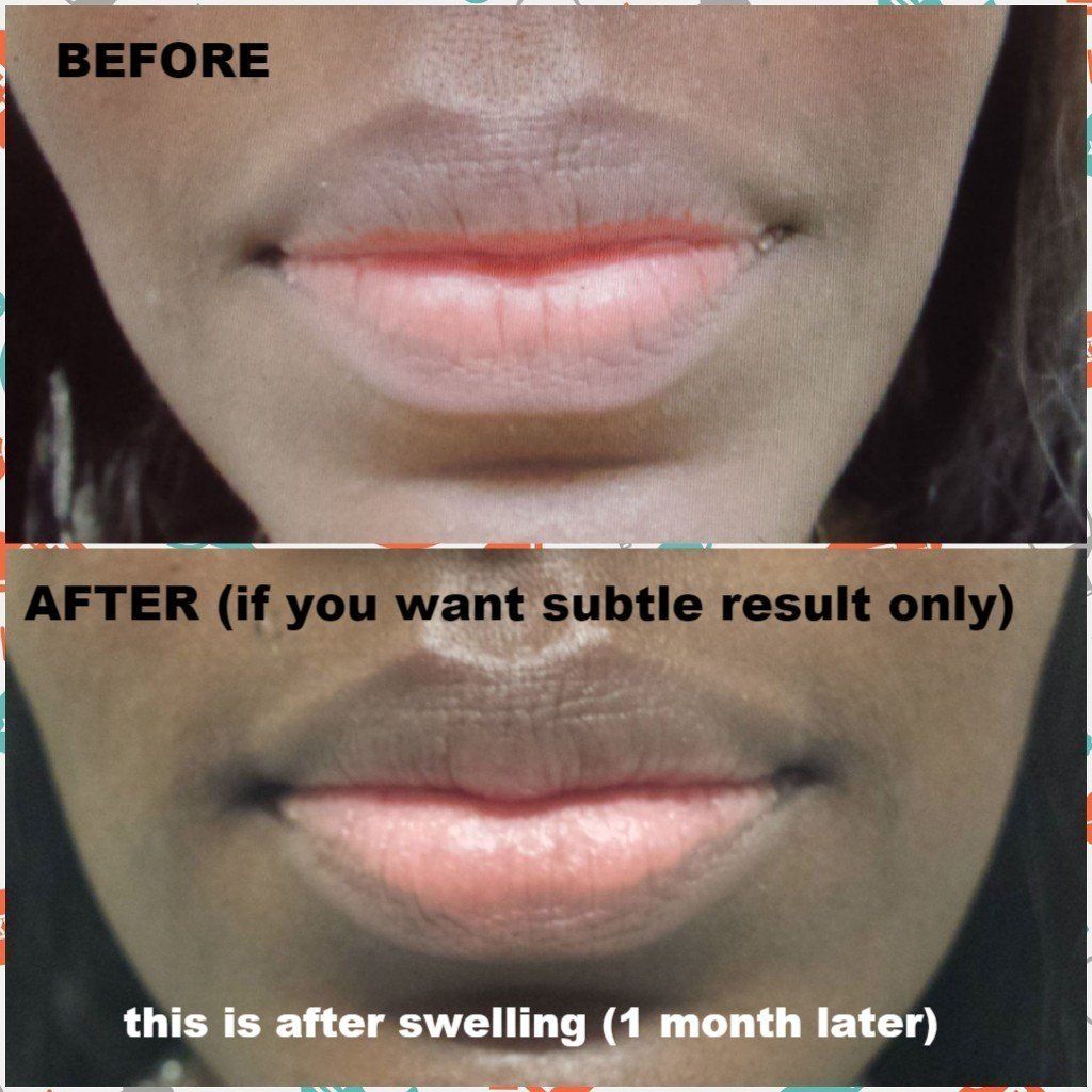 lip filler fuller lips plump pout restylane juvaderm versa